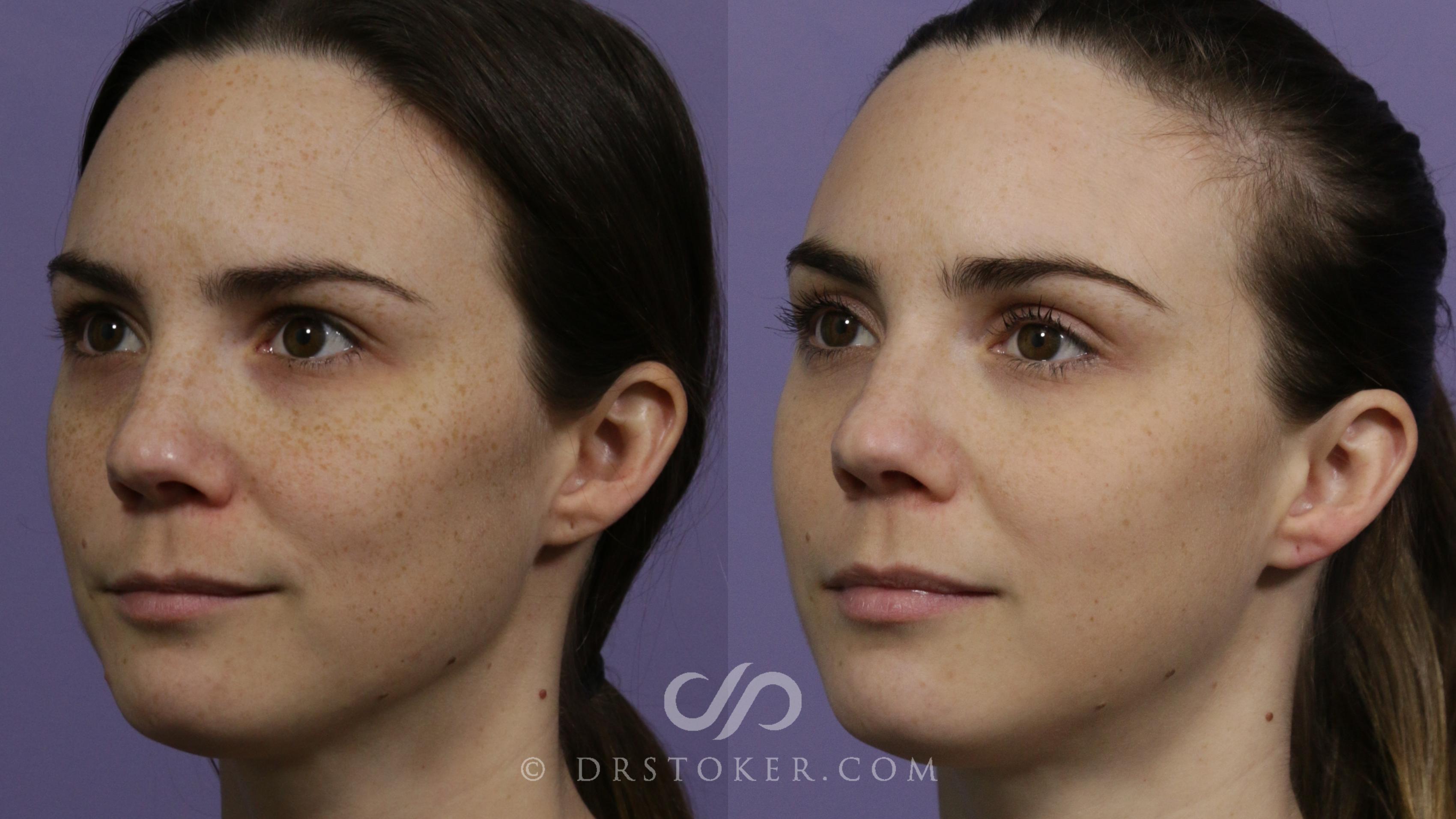 Before & After Skin Rejuvenation Treatments Case 2289 Front View in Los Angeles, CA