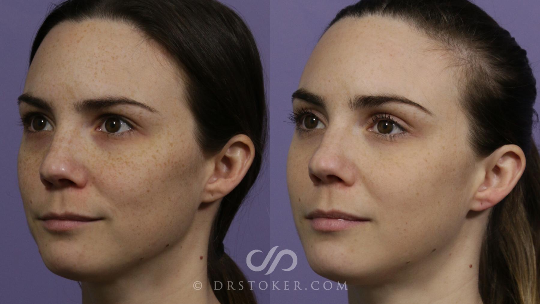 Before & After Chemical Peels Case 2289 Front View in Los Angeles, CA