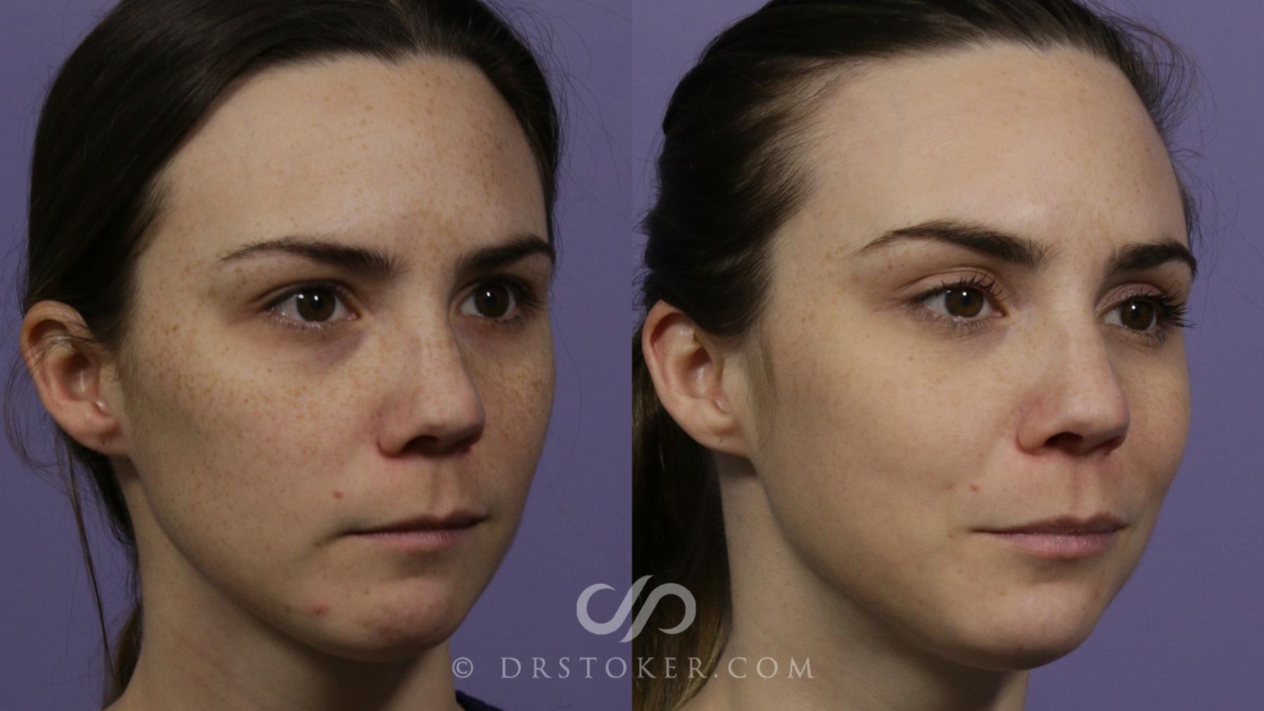 Before & After Skin Rejuvenation Treatments Case 2290 Right Oblique View in Los Angeles, CA