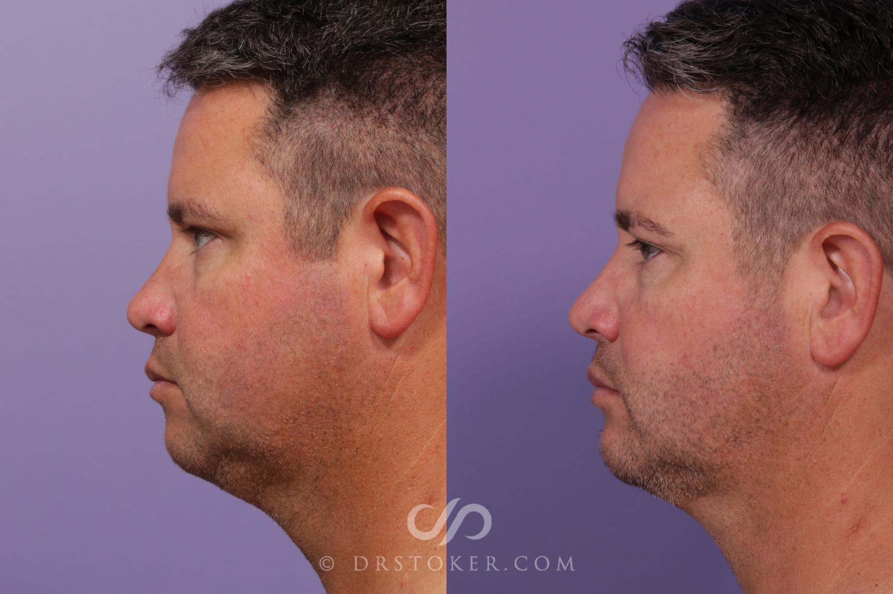 Before & After Chin Augmentation Case 1744 View #1 View in Los Angeles, CA