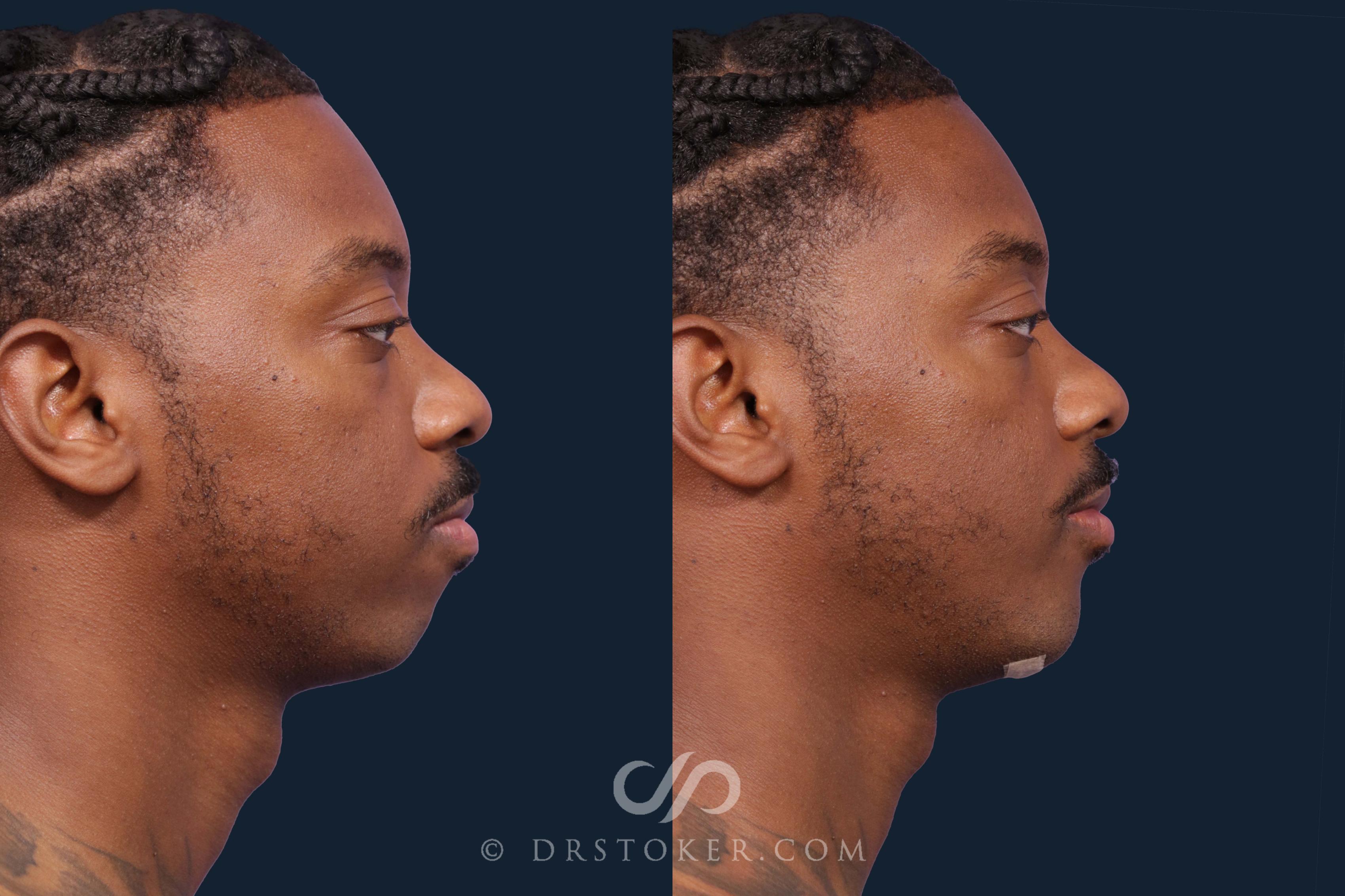 Before & After Chin Augmentation Case 1904 Right Side View in Los Angeles, CA