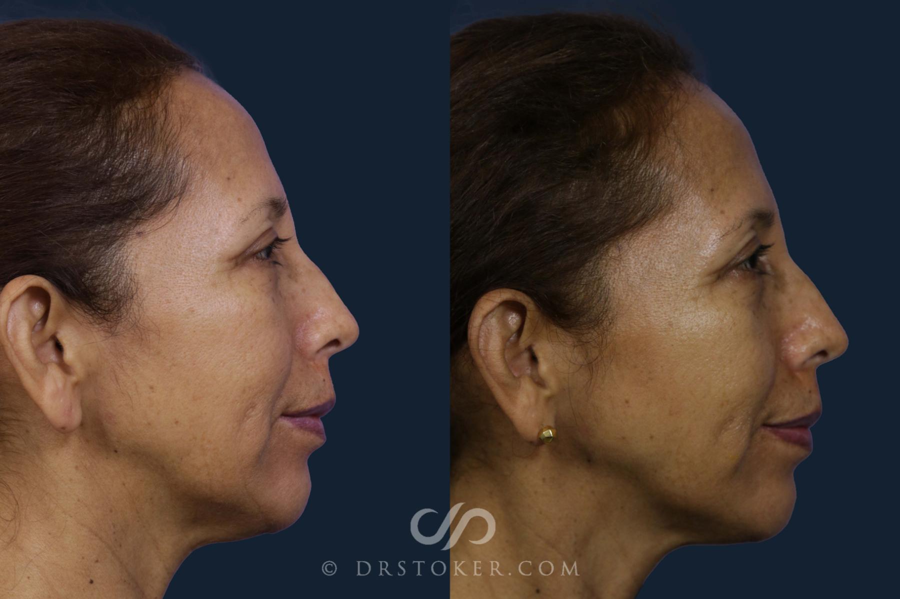 Before & After Chin Augmentation Case 1940 Right Side View in Los Angeles, CA