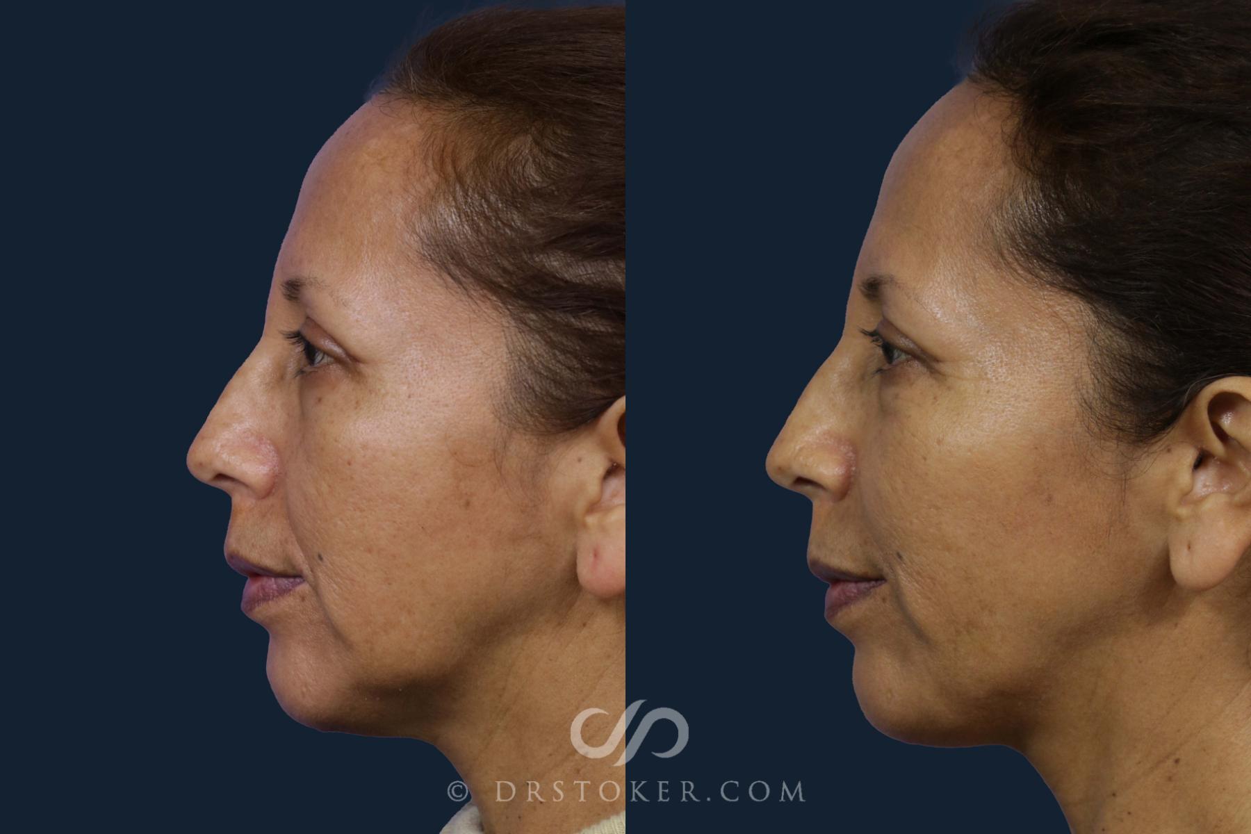 Before & After Chin Augmentation Case 1941 Left Side View in Los Angeles, CA