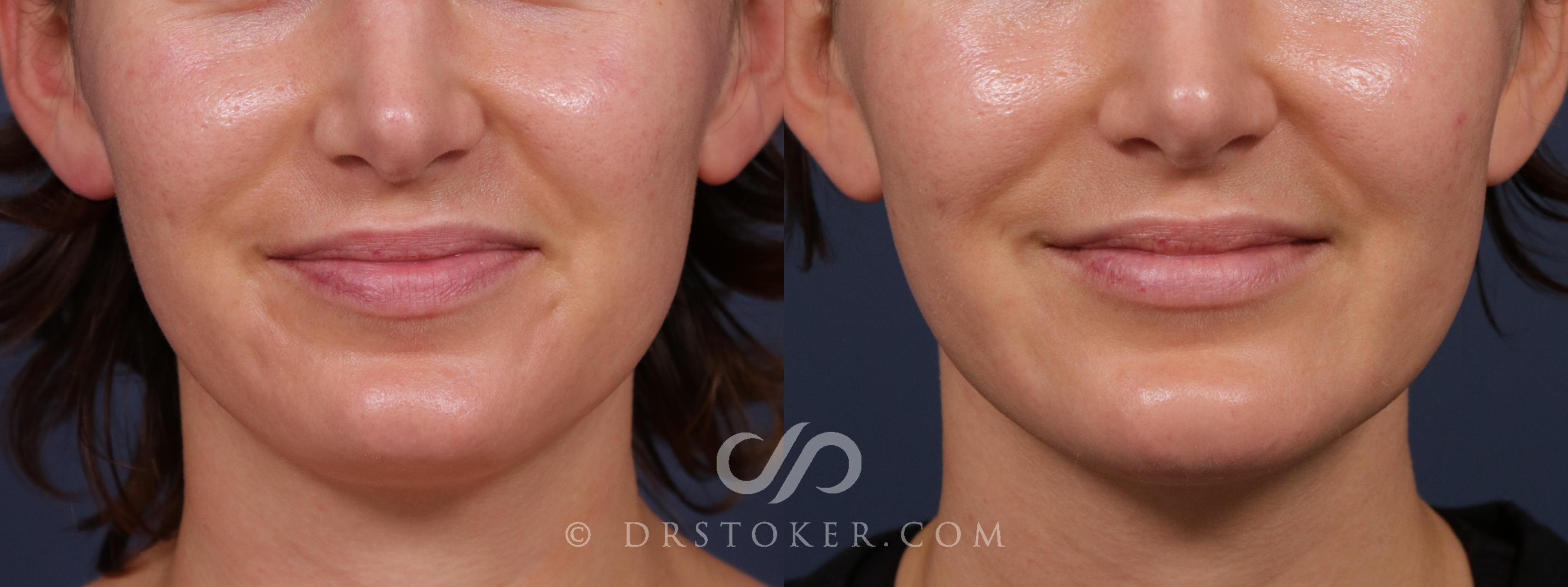 Before & After Chin Augmentation Case 2052 Front View in Los Angeles, CA