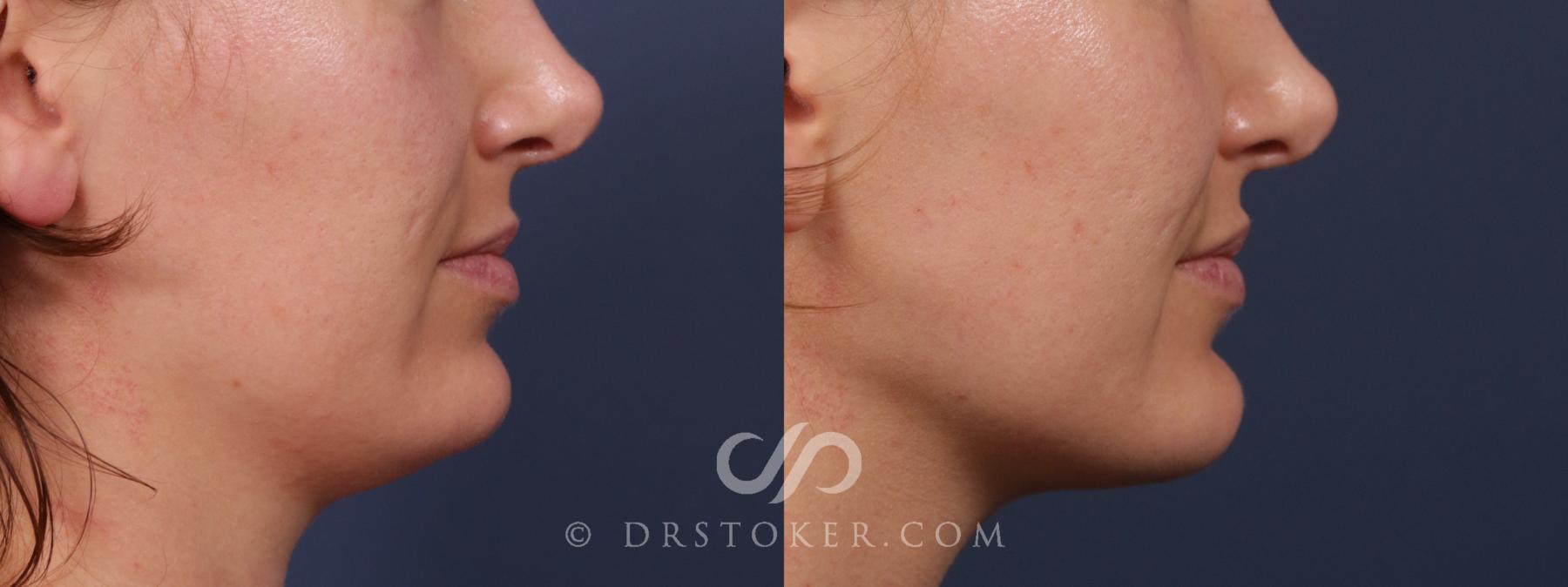 Before & After Chin Augmentation Case 2052 Right Side View in Los Angeles, CA