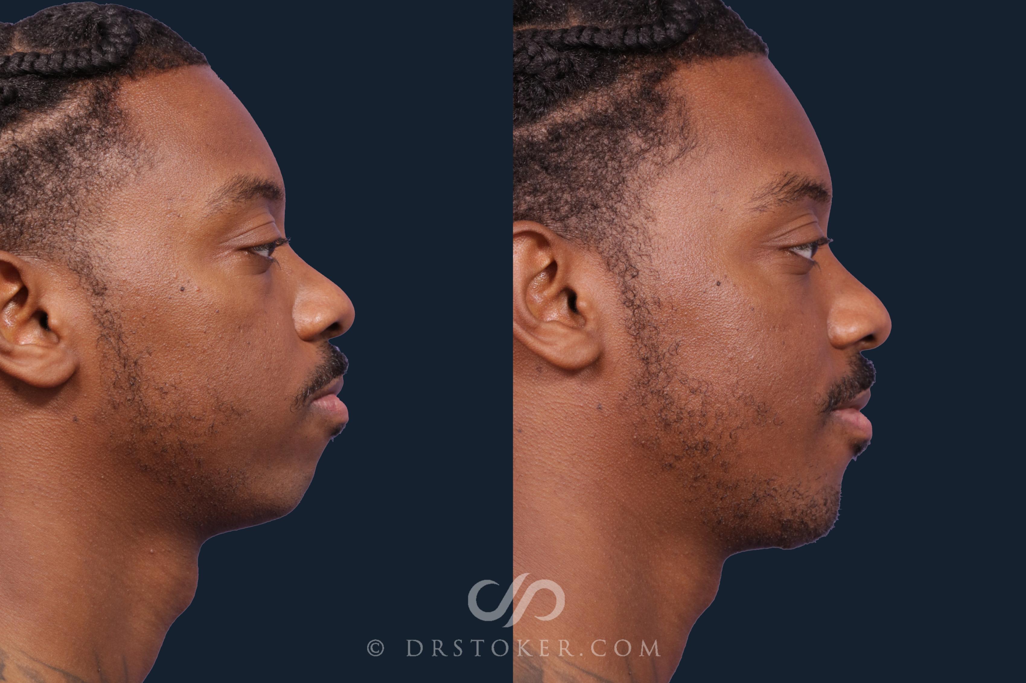 Before & After Chin Augmentation Case 2154 Right Side View in Los Angeles, CA