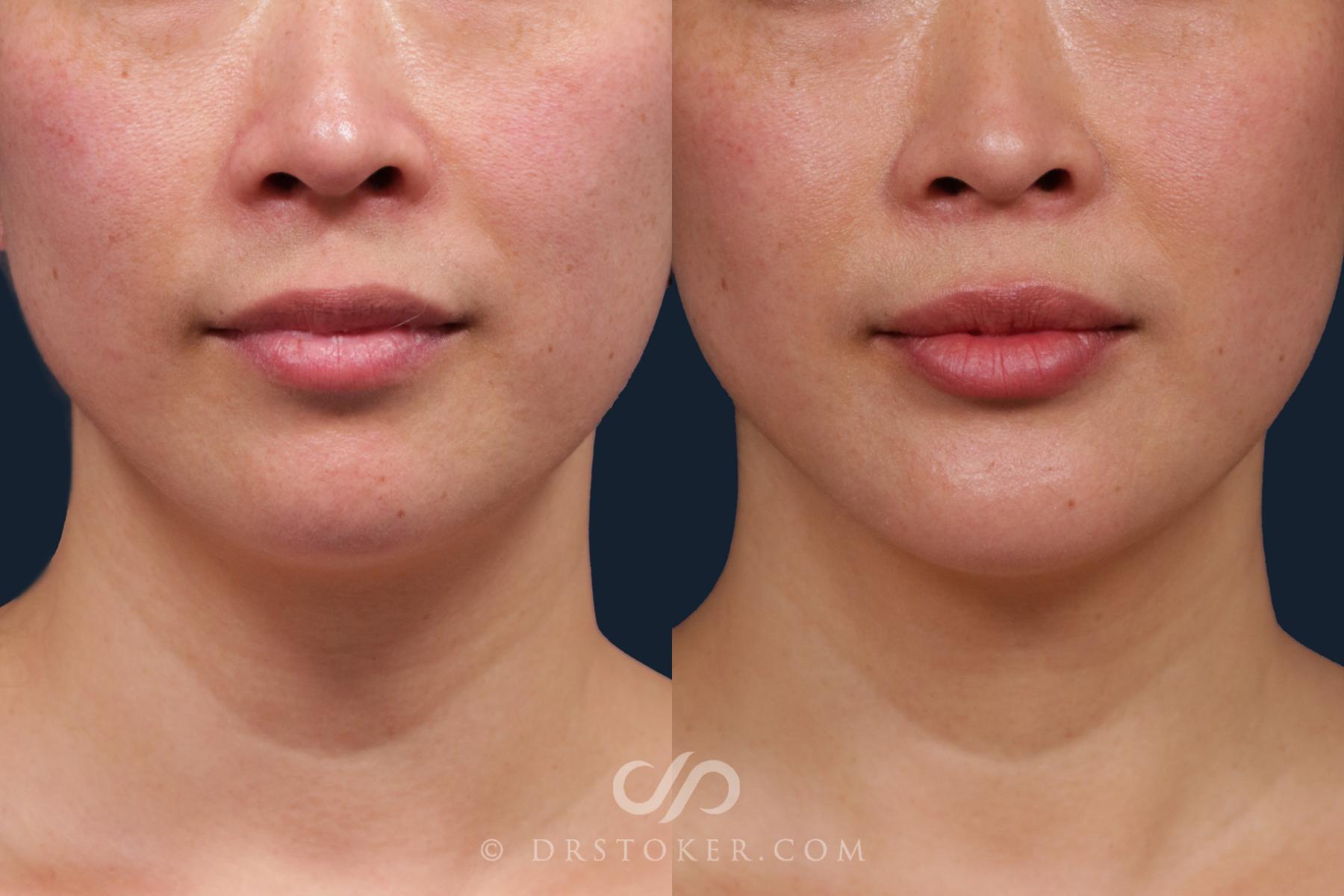 Before & After Chin Augmentation Case 2165 Front View in Los Angeles, CA