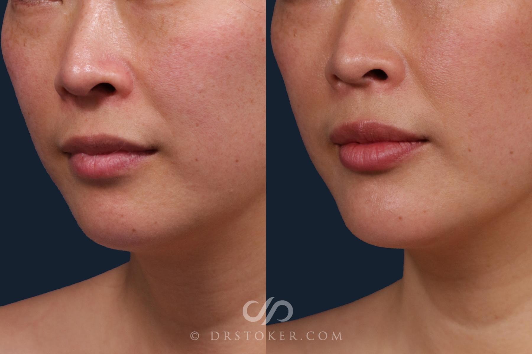 Before & After Chin Augmentation Case 2165 Left Oblique View in Los Angeles, CA