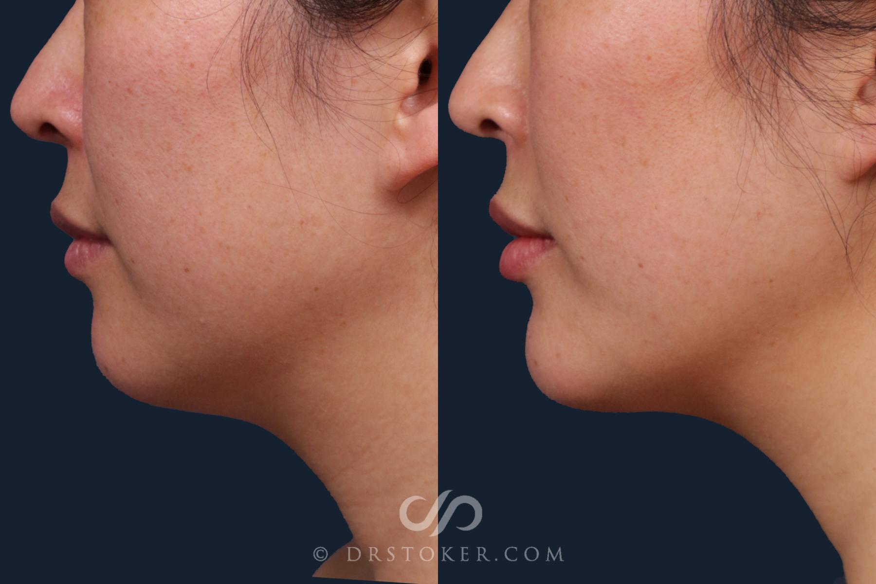 Before & After Chin Augmentation Case 2165 Left Side View in Los Angeles, CA