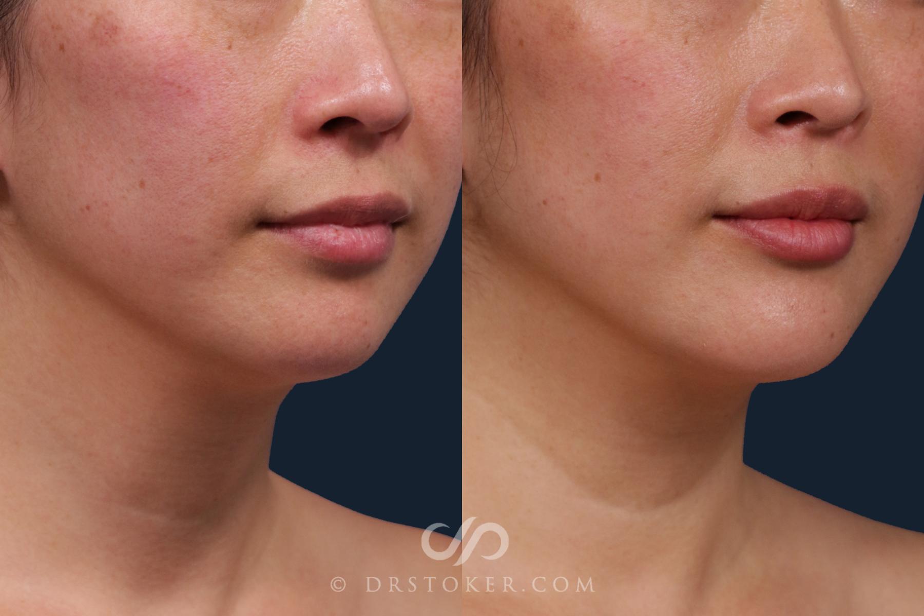 Before & After Chin Augmentation Case 2165 Right Oblique View in Los Angeles, CA
