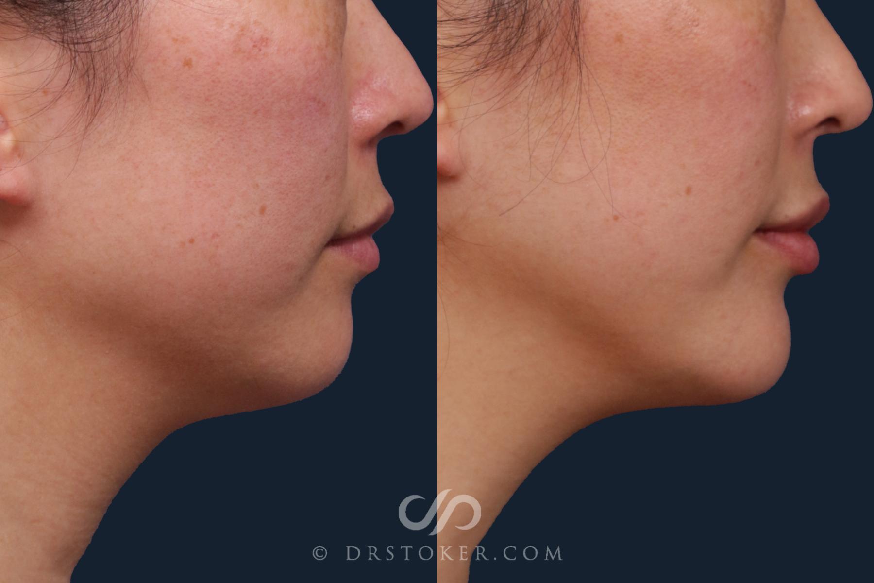 Before & After Chin Augmentation Case 2165 Right Side View in Los Angeles, CA