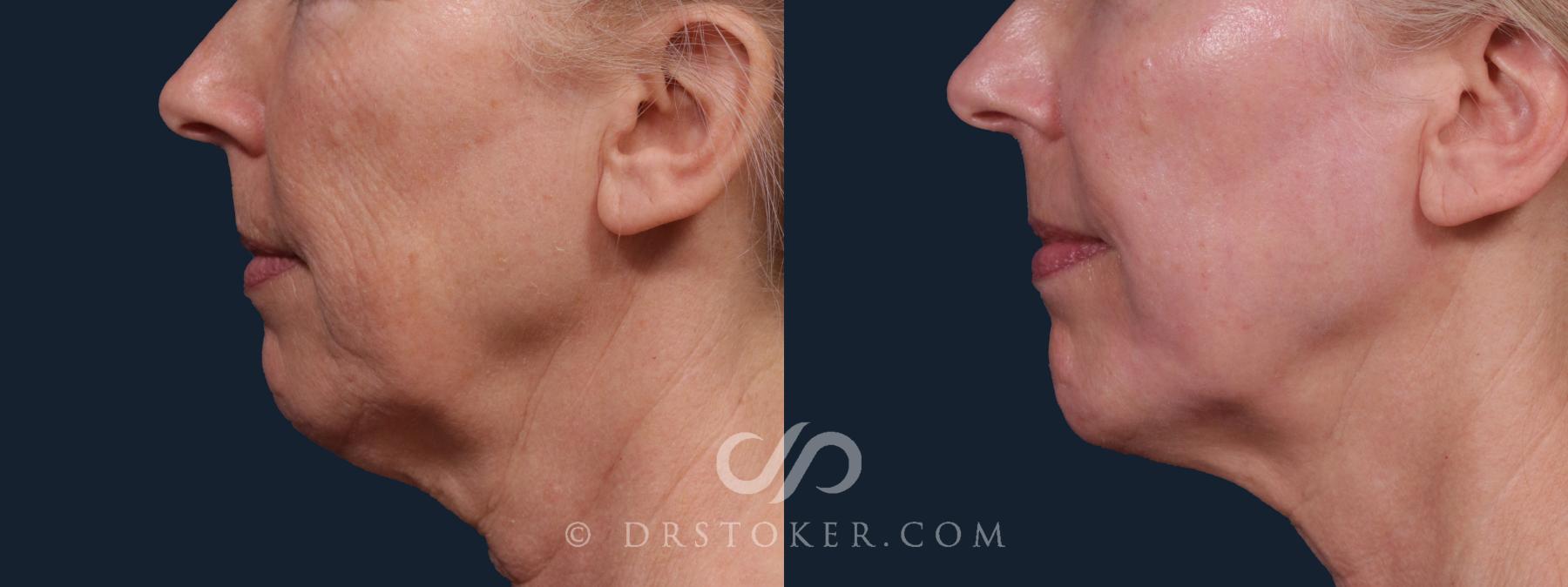 Before & After Chin Augmentation Case 2198 Left Side View in Los Angeles, CA