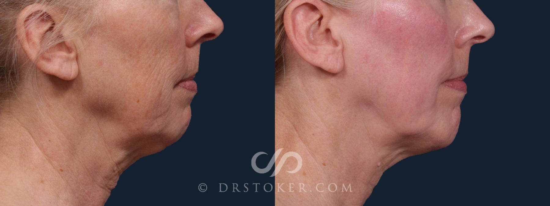 Before & After Chin Augmentation Case 2198 Right Side View in Los Angeles, CA