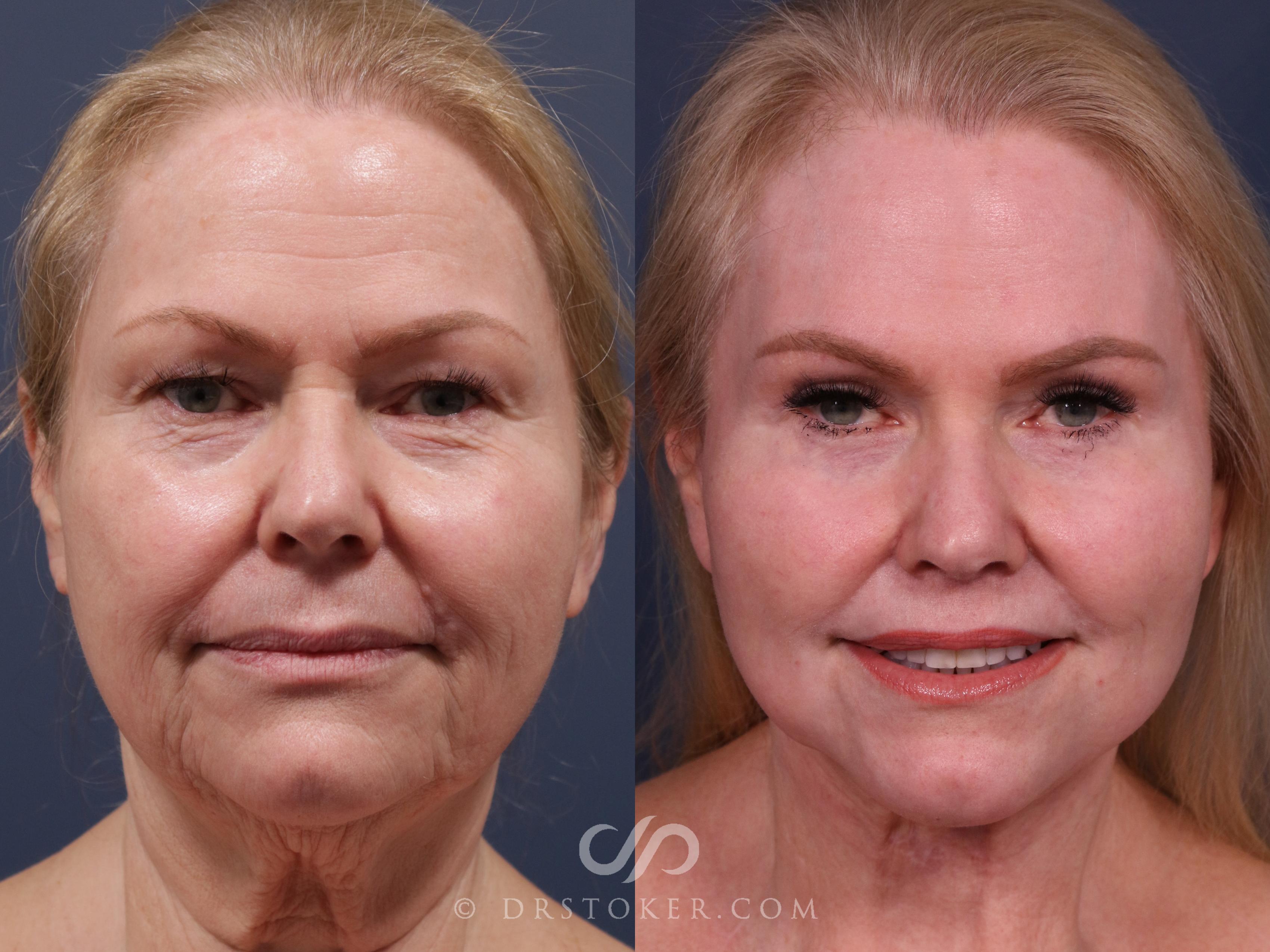 Before & After Chin Augmentation Case 2306 Front View in Los Angeles, CA