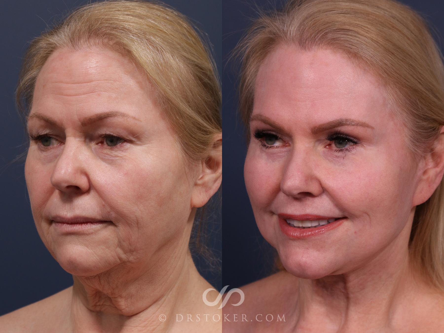 Before & After Chin Augmentation Case 2306 Left Oblique View in Los Angeles, CA