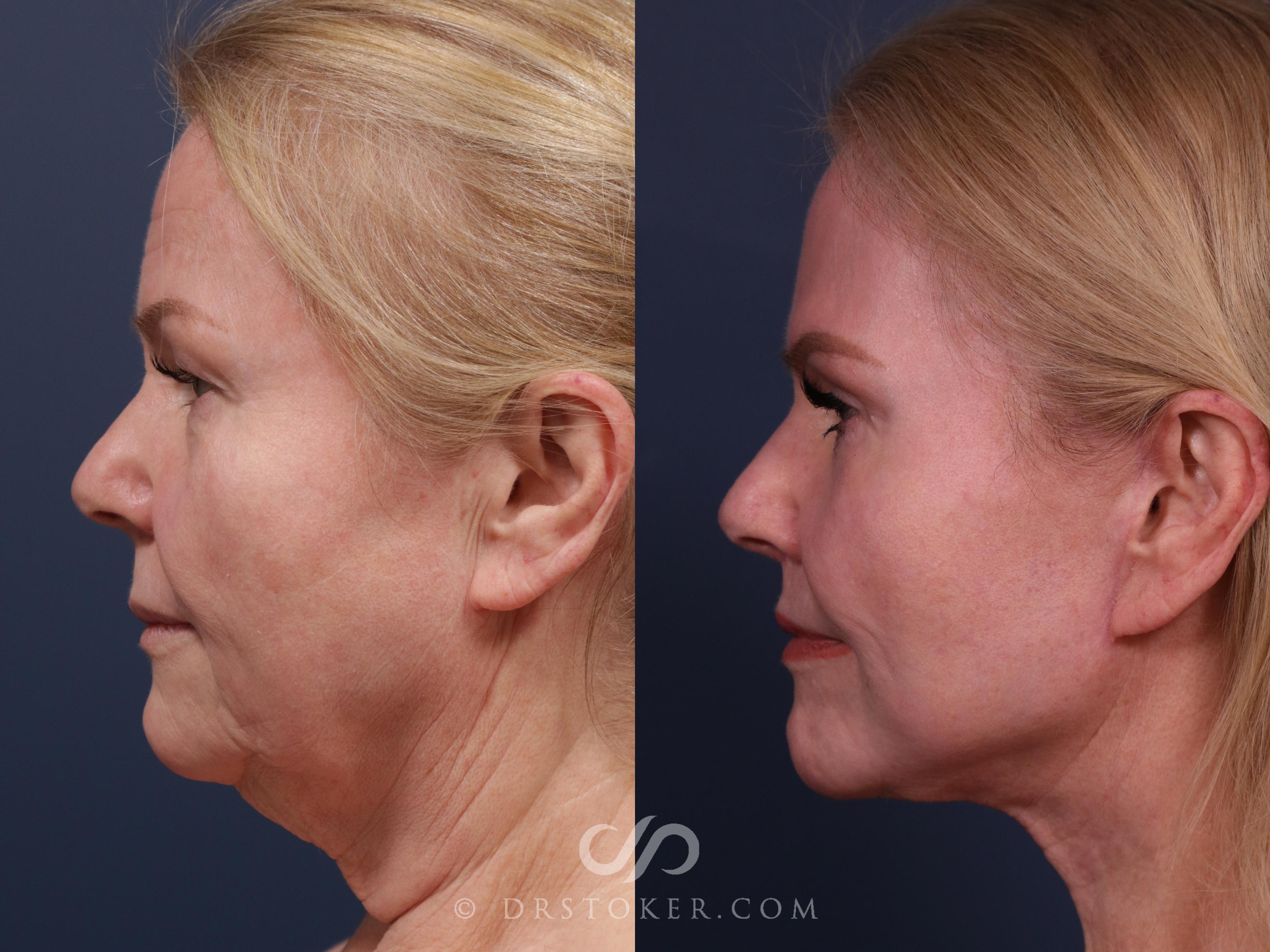 Before & After Chin Augmentation Case 2306 Left Side View in Los Angeles, CA