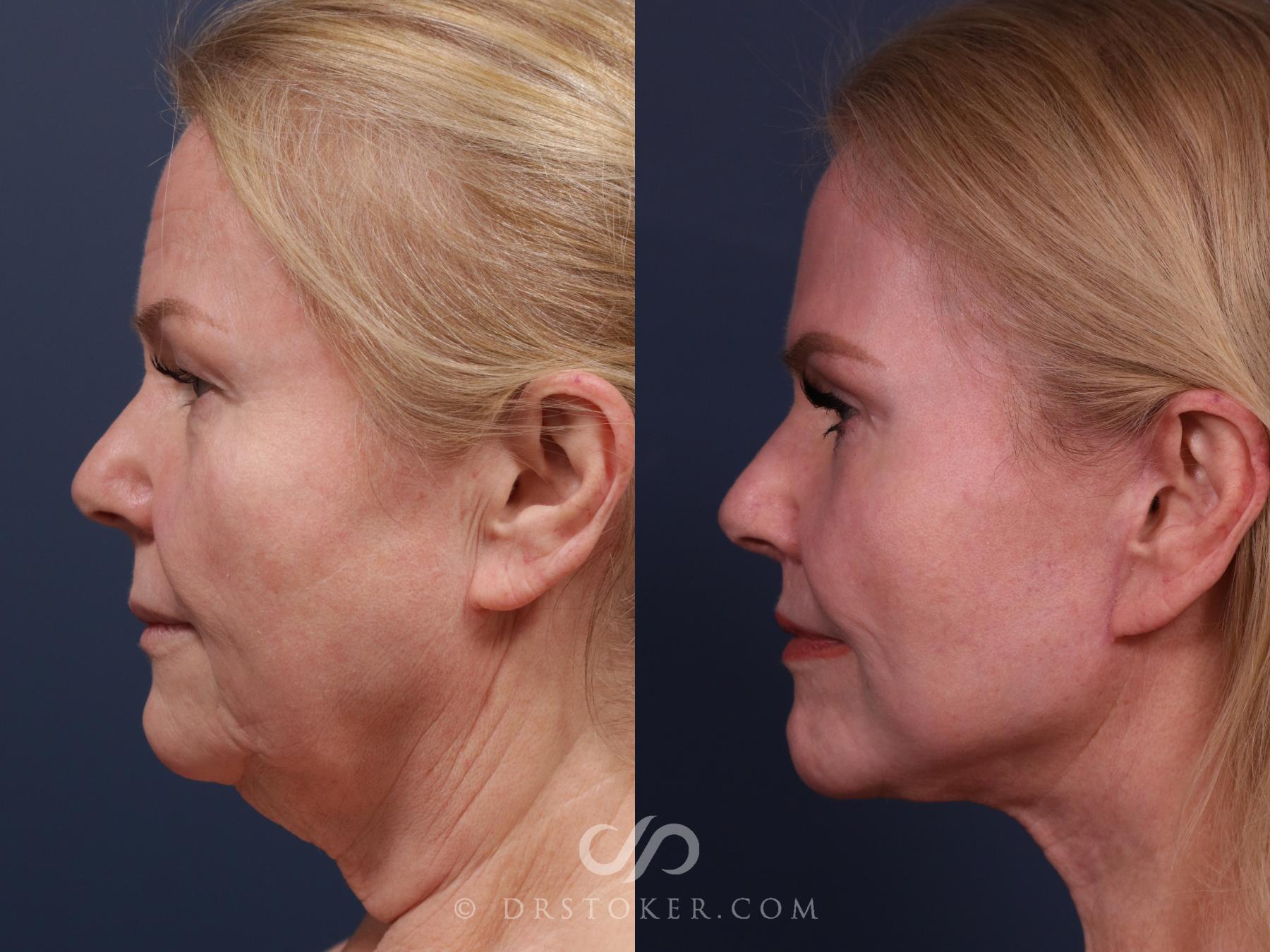 Before & After Chin Augmentation Case 2306 Left Side View in Los Angeles, CA