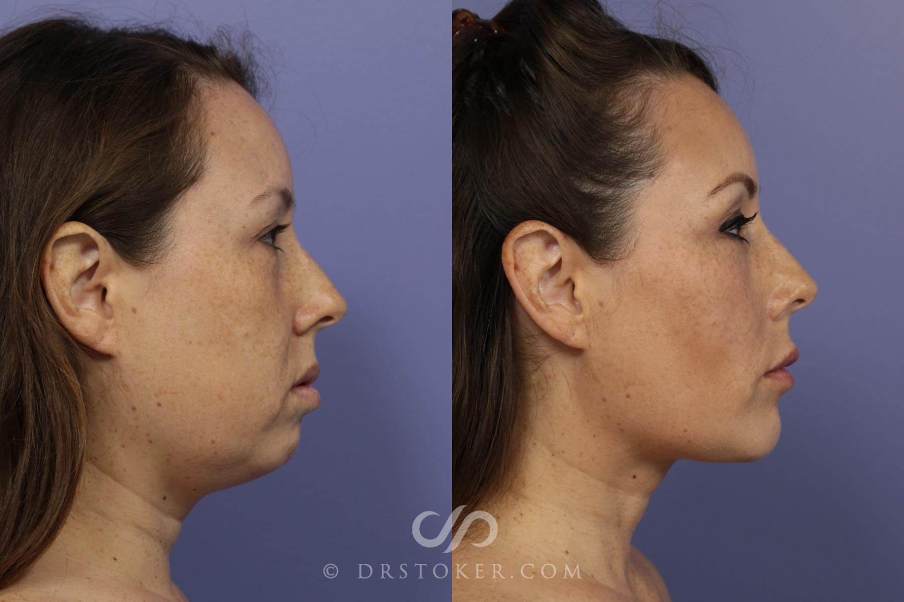 Before & After Chin Augmentation Case 837 View #1 View in Los Angeles, CA