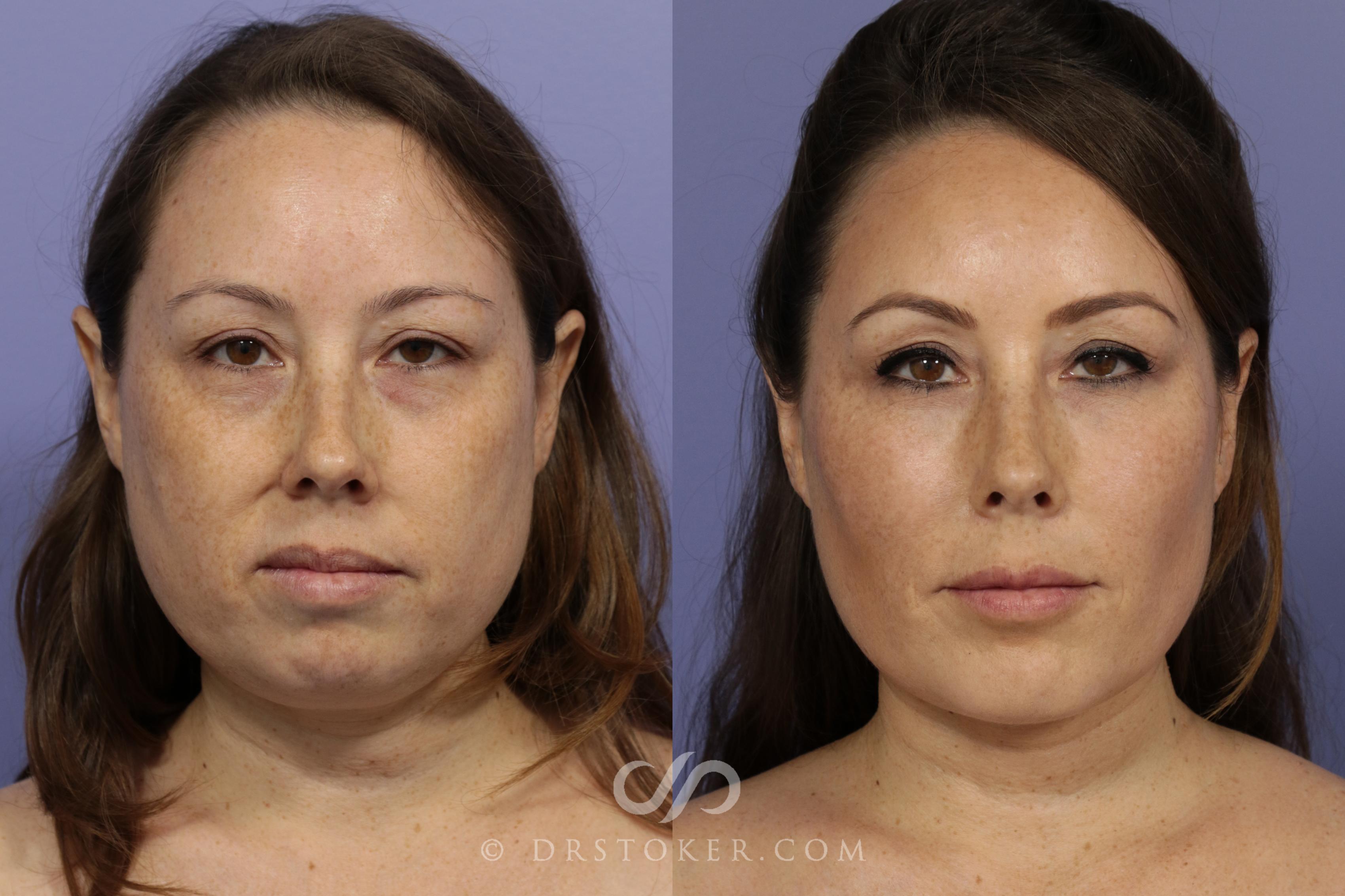 Before & After Chin Augmentation Case 837 View #2 View in Los Angeles, CA