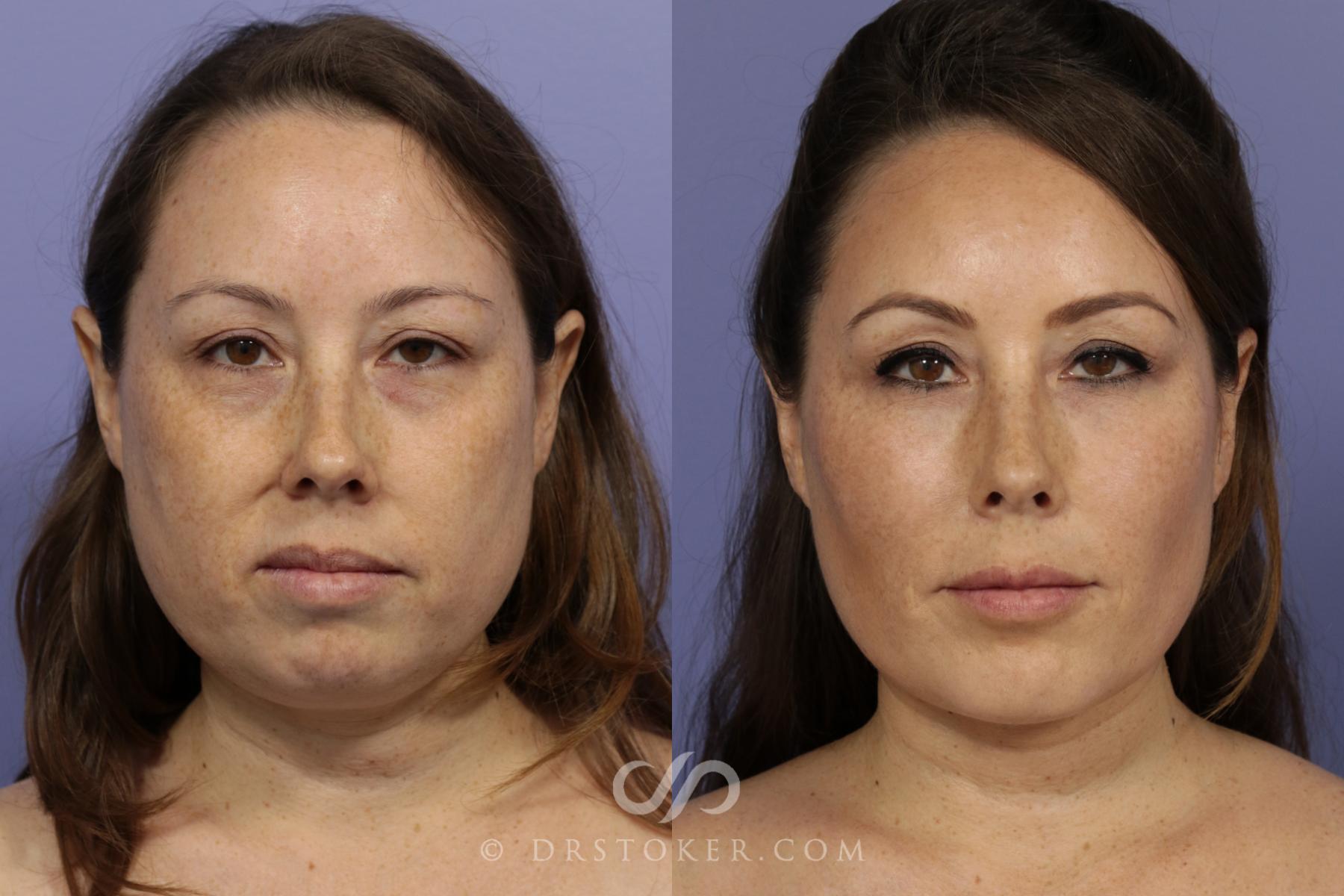 Before & After Chin Augmentation Case 837 View #2 View in Los Angeles, CA