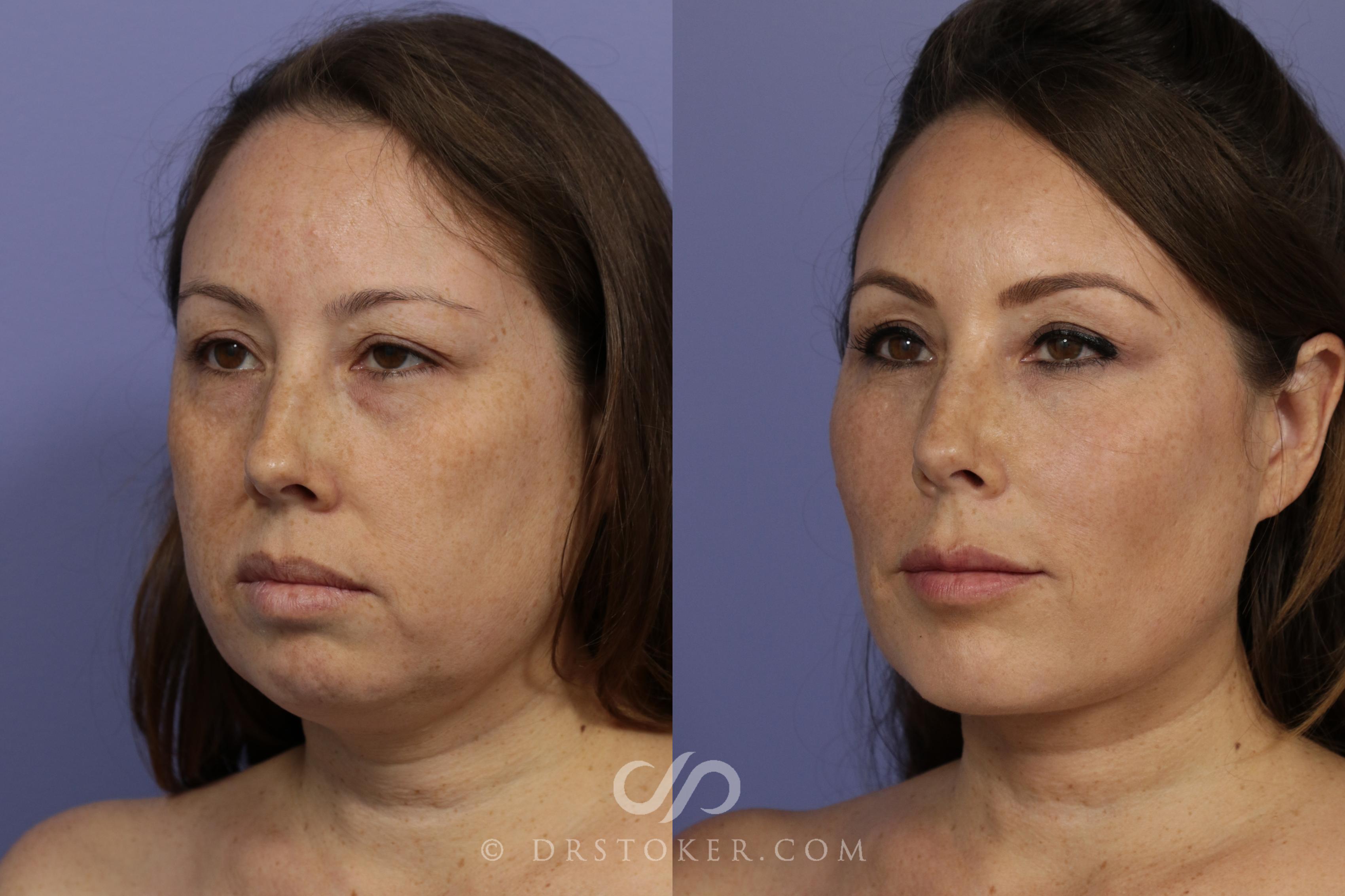 Before & After Chin Augmentation Case 837 View #3 View in Los Angeles, CA