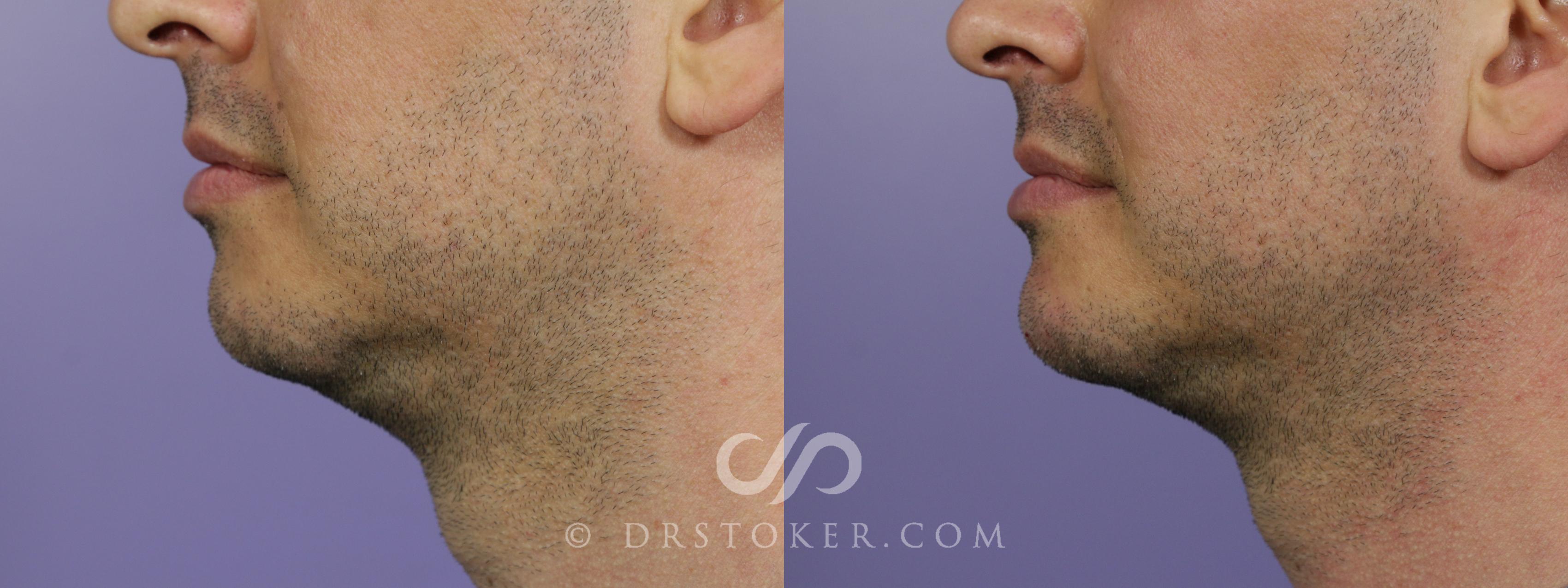 Before & After Facial Fillers Case 1597 View #1 View in Marina del Rey, CA