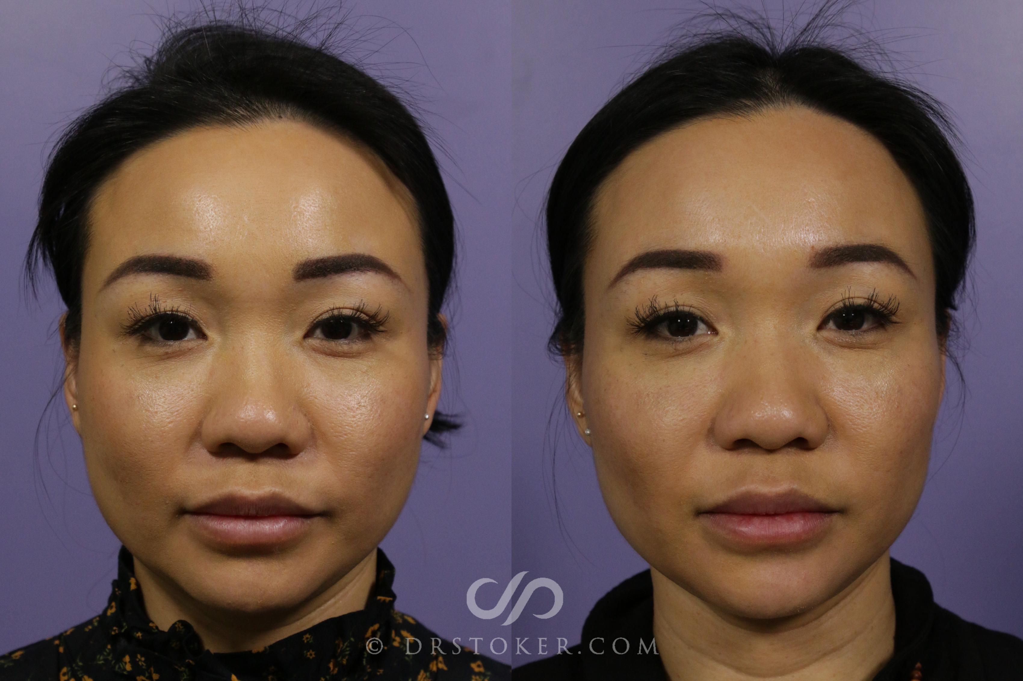 Before & After Chin Fillers/Augmentation Case 1884 Front View in Los Angeles, CA