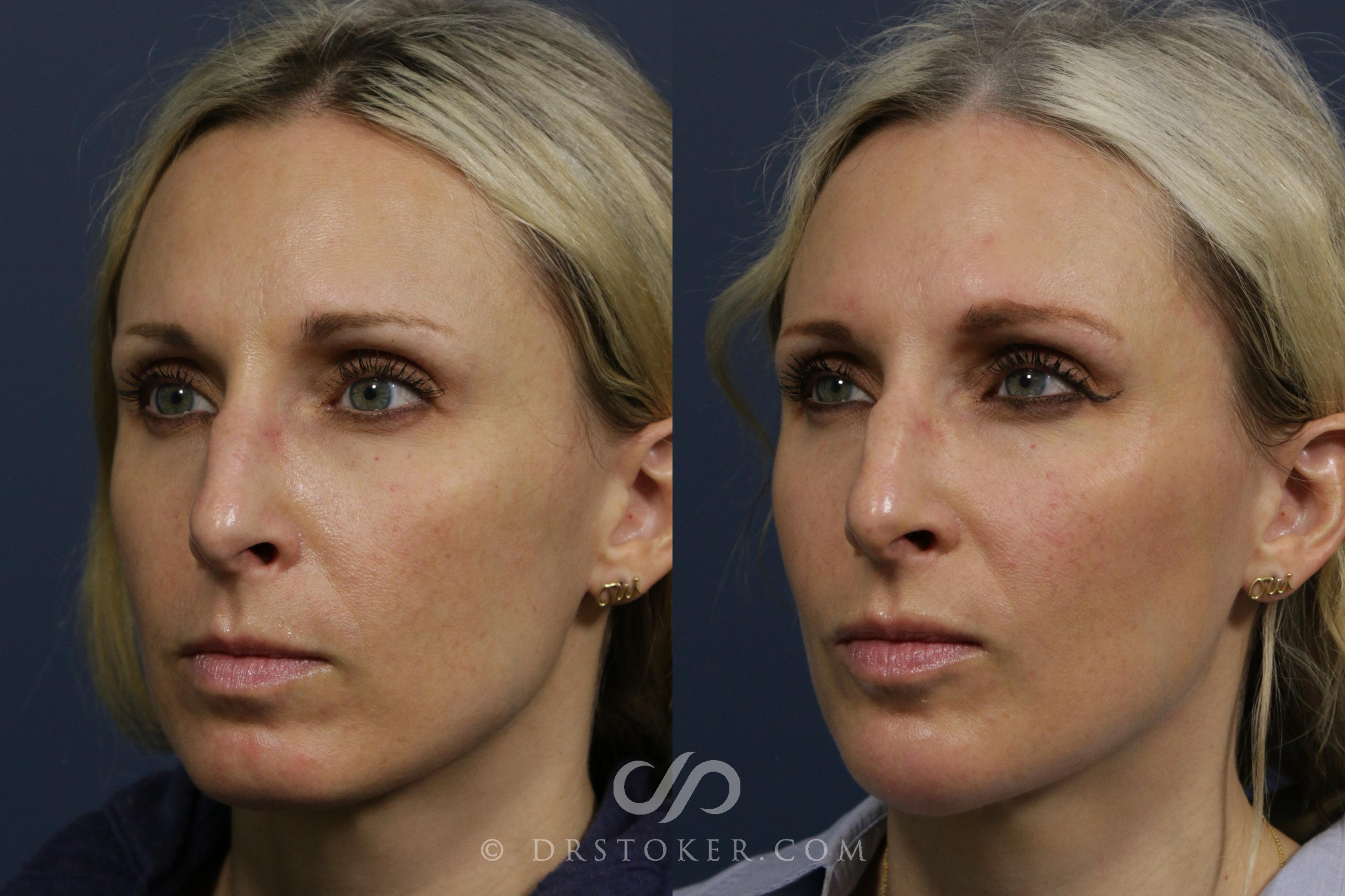 Before & After Chin Fillers Case 2270 Left Oblique View in Los Angeles, CA