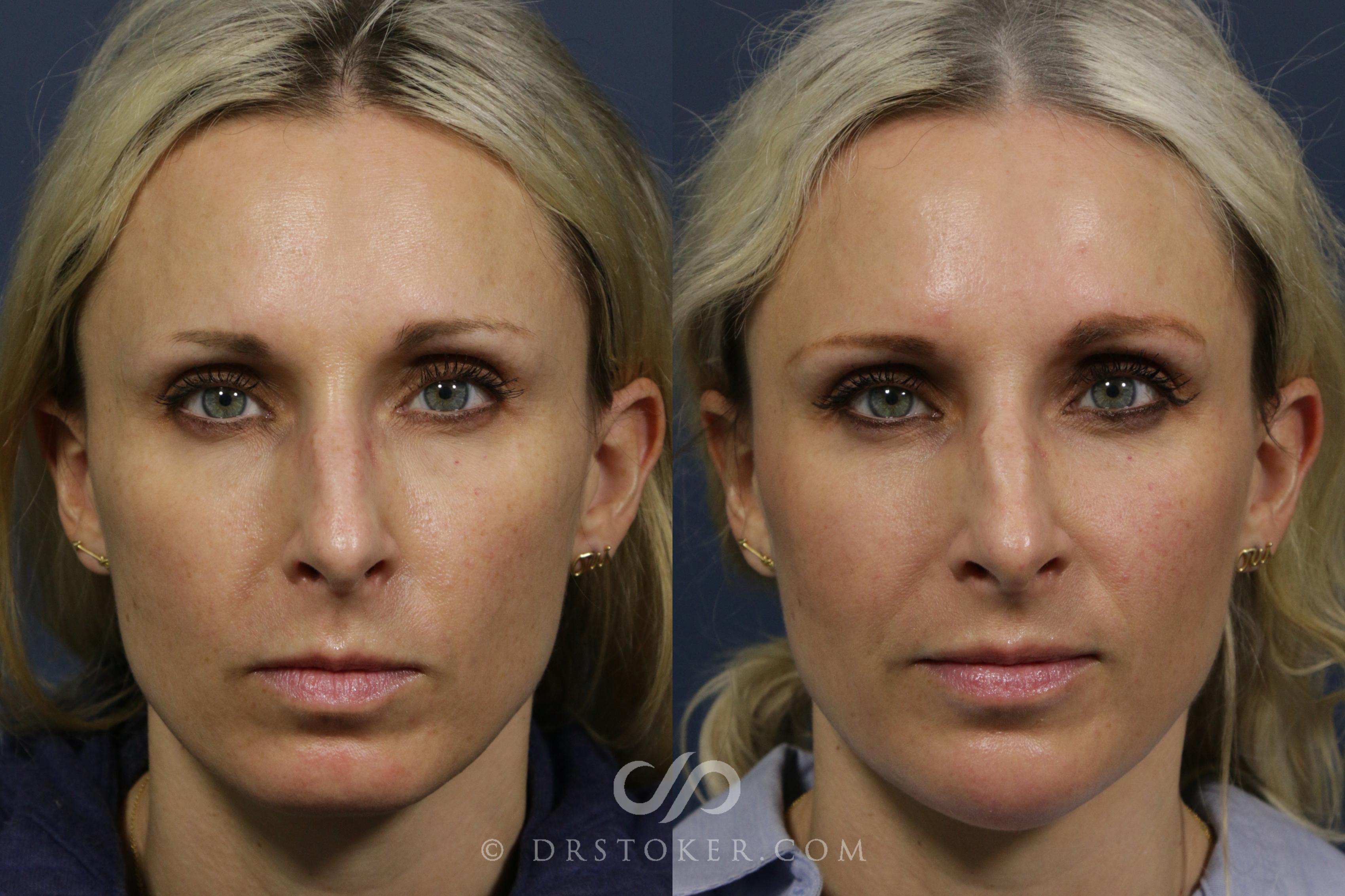 Before & After Chin Fillers Case 2272 Front View in Los Angeles, CA