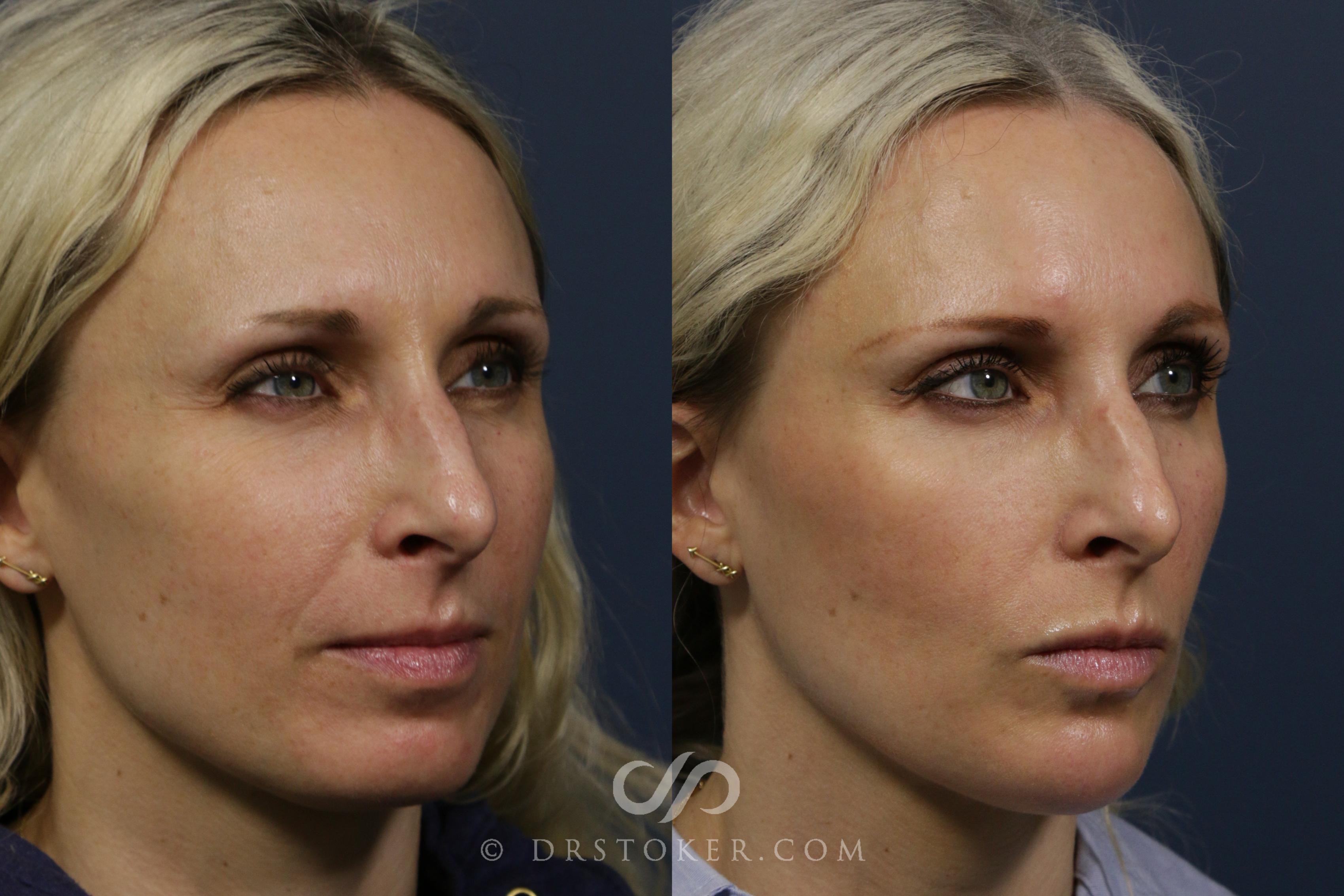 Before & After Chin Fillers Case 2273 Right Oblique View in Los Angeles, CA