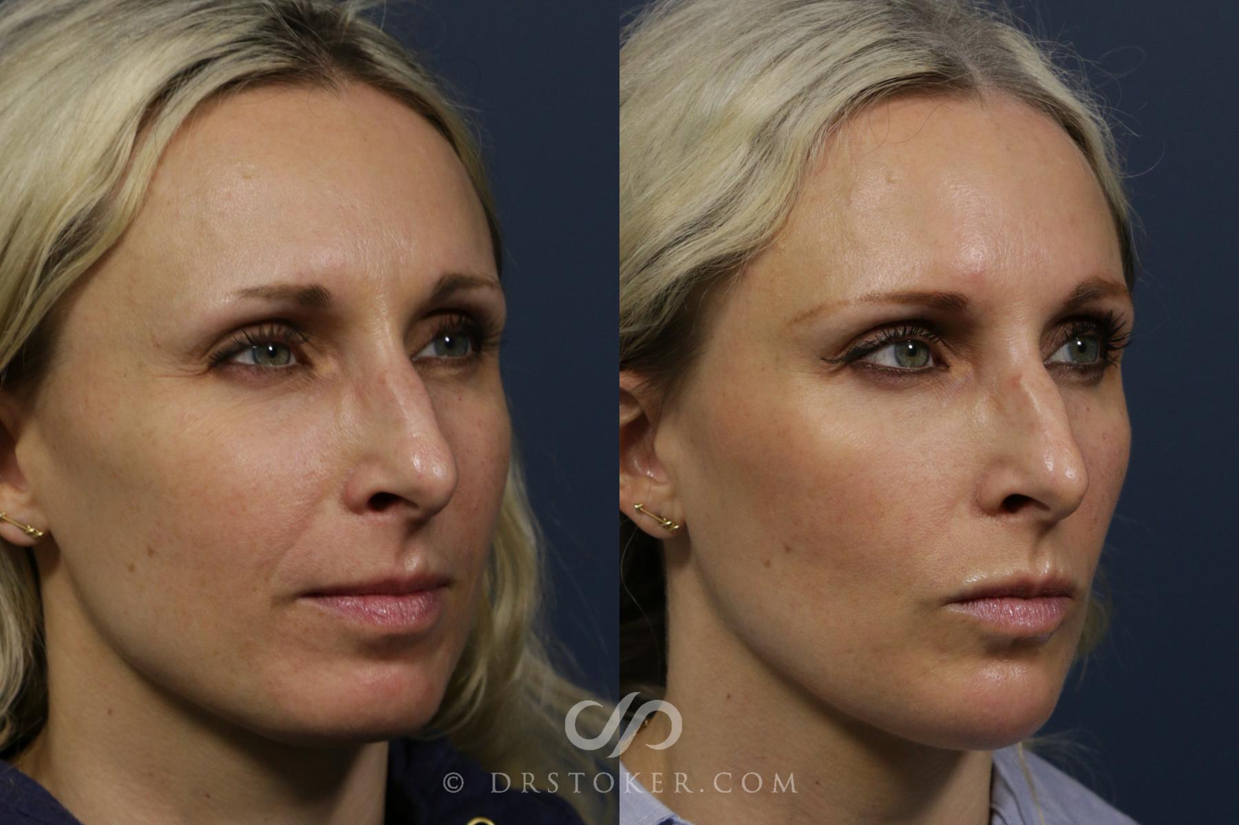 Before & After Chin Fillers Case 2273 Right Oblique View in Los Angeles, CA