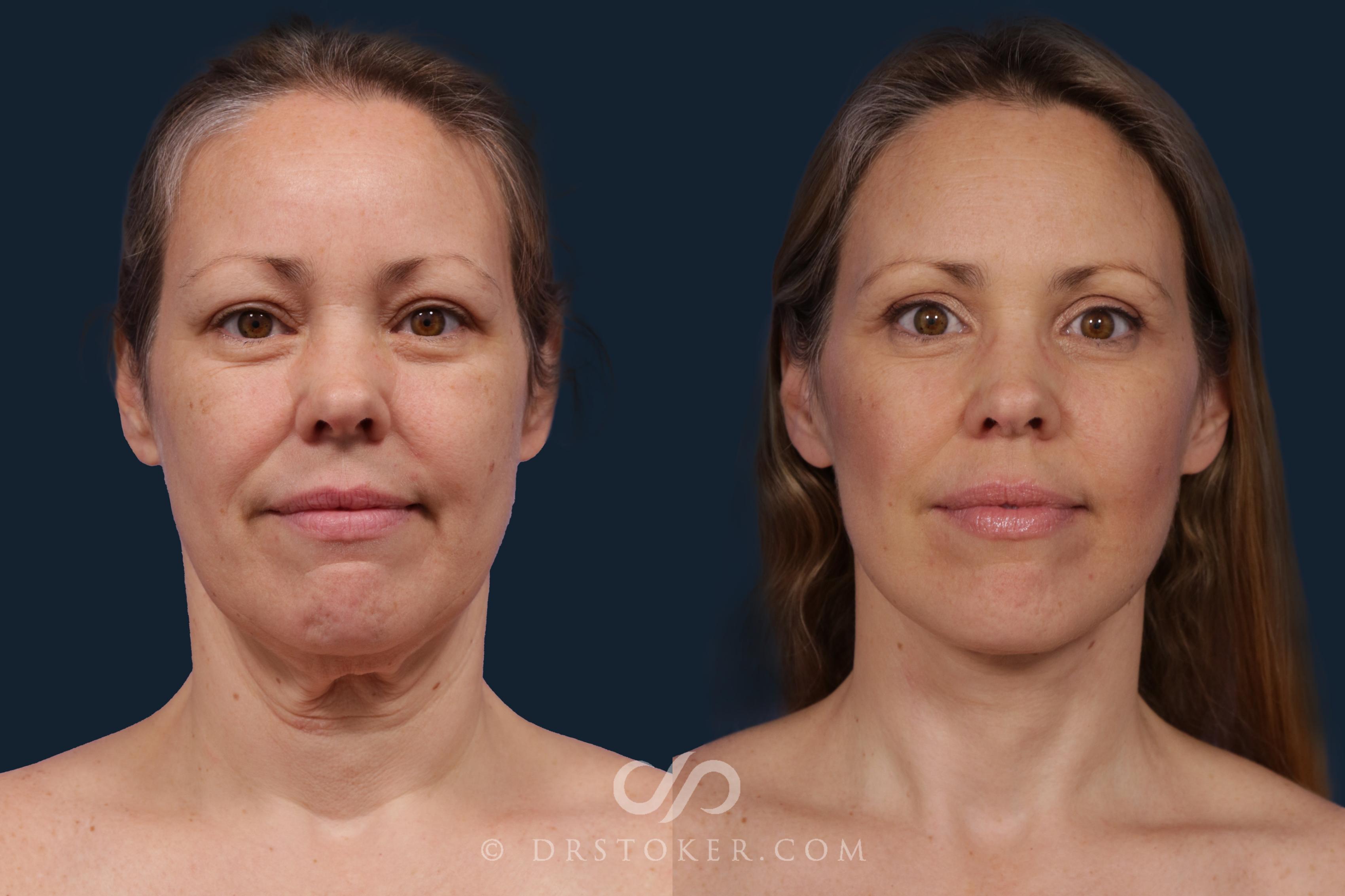 Before & After Deep Plane Facelift/Neck Lift - Traceless Deep Plane Facelift Case 2121 Front View in Los Angeles, CA