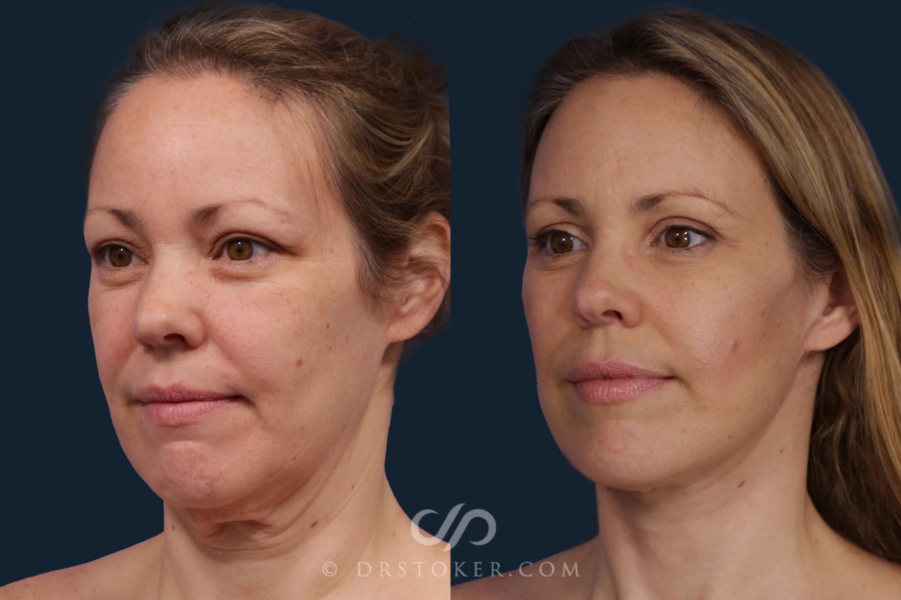 Before & After Facelift/Neck Lift (Deep Plane/Traceless) Case 2121 Left Oblique View in Los Angeles, CA