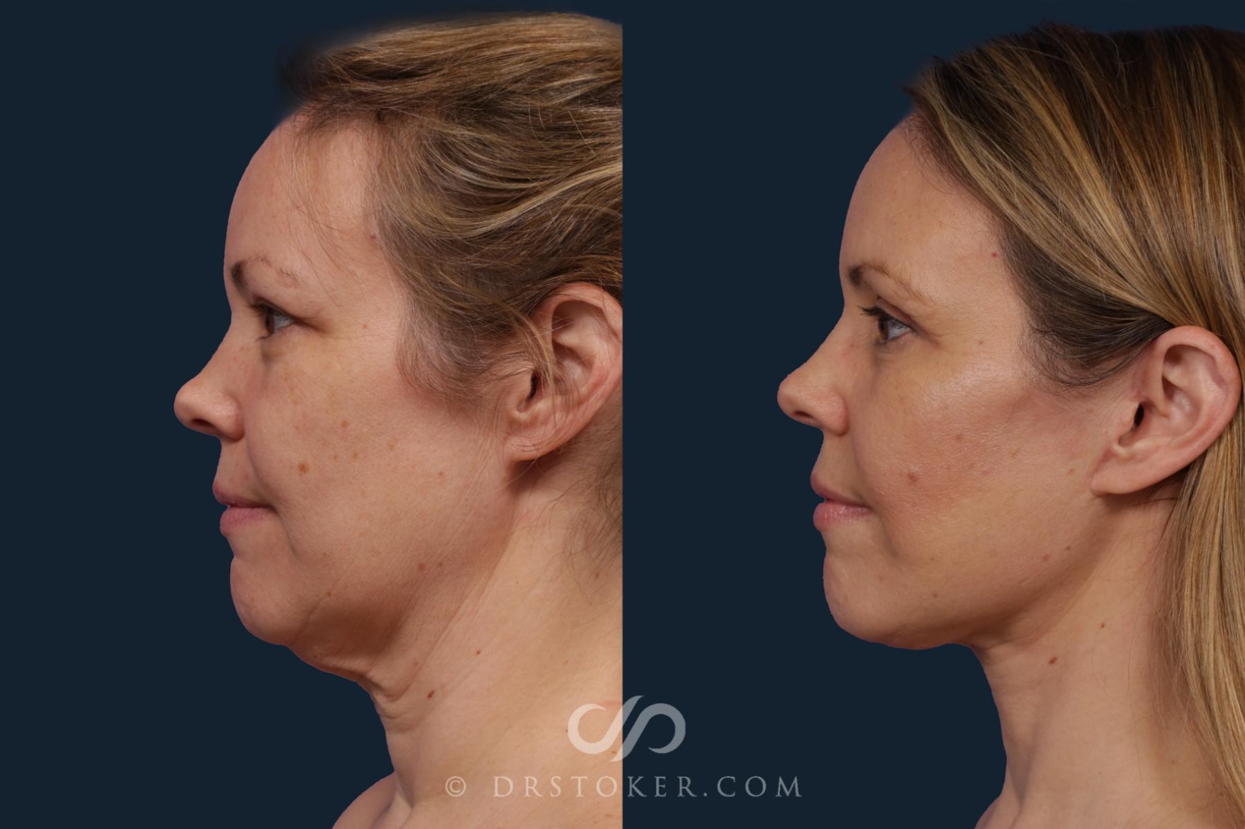 Before & After Facelift/Neck Lift (Deep Plane/Traceless) Case 2121 Left Side View in Los Angeles, CA