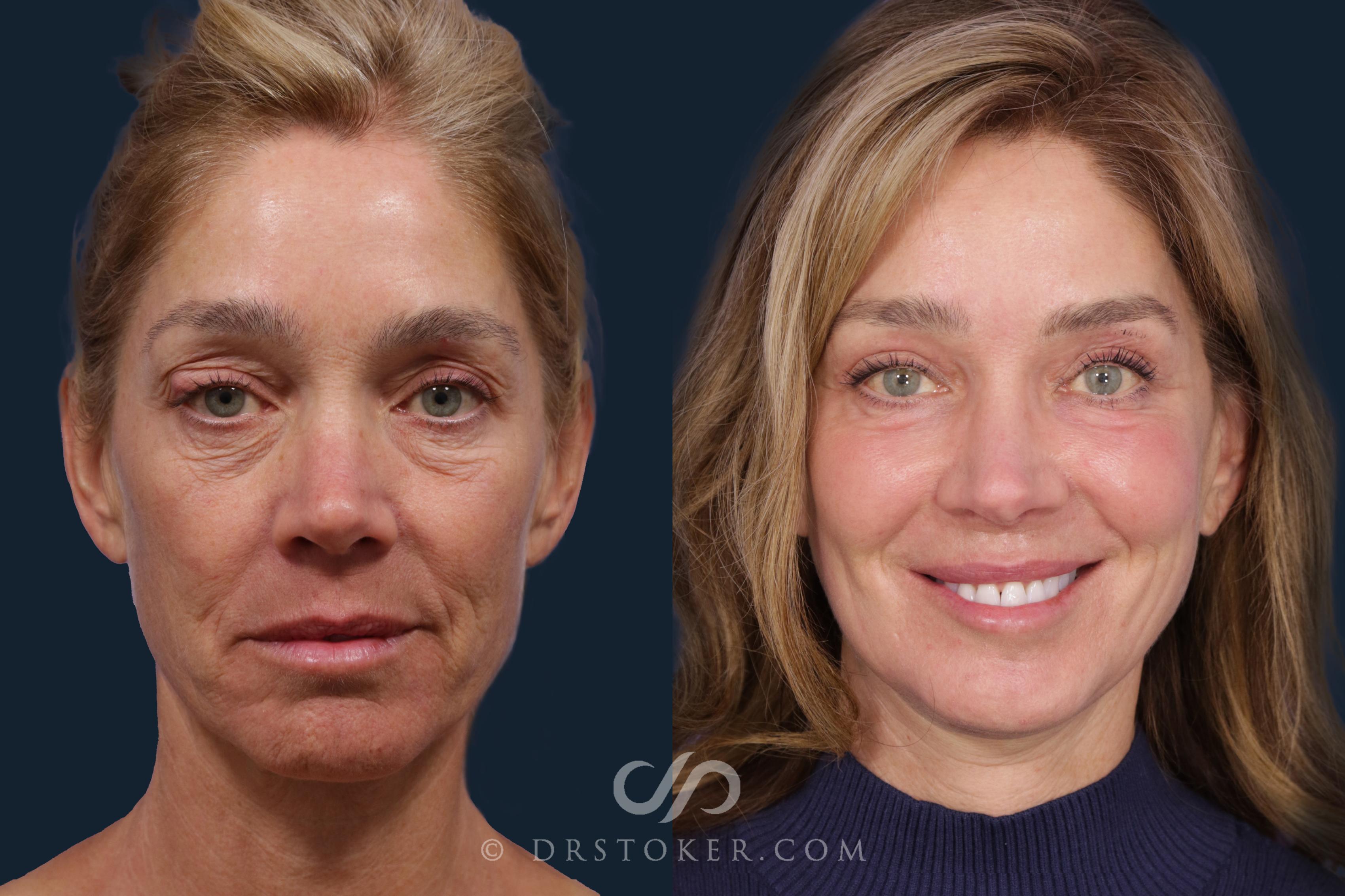 Before & After Deep Plane Facelift/Neck Lift - Traceless Deep Plane Facelift Case 2122 Front View in Los Angeles, CA