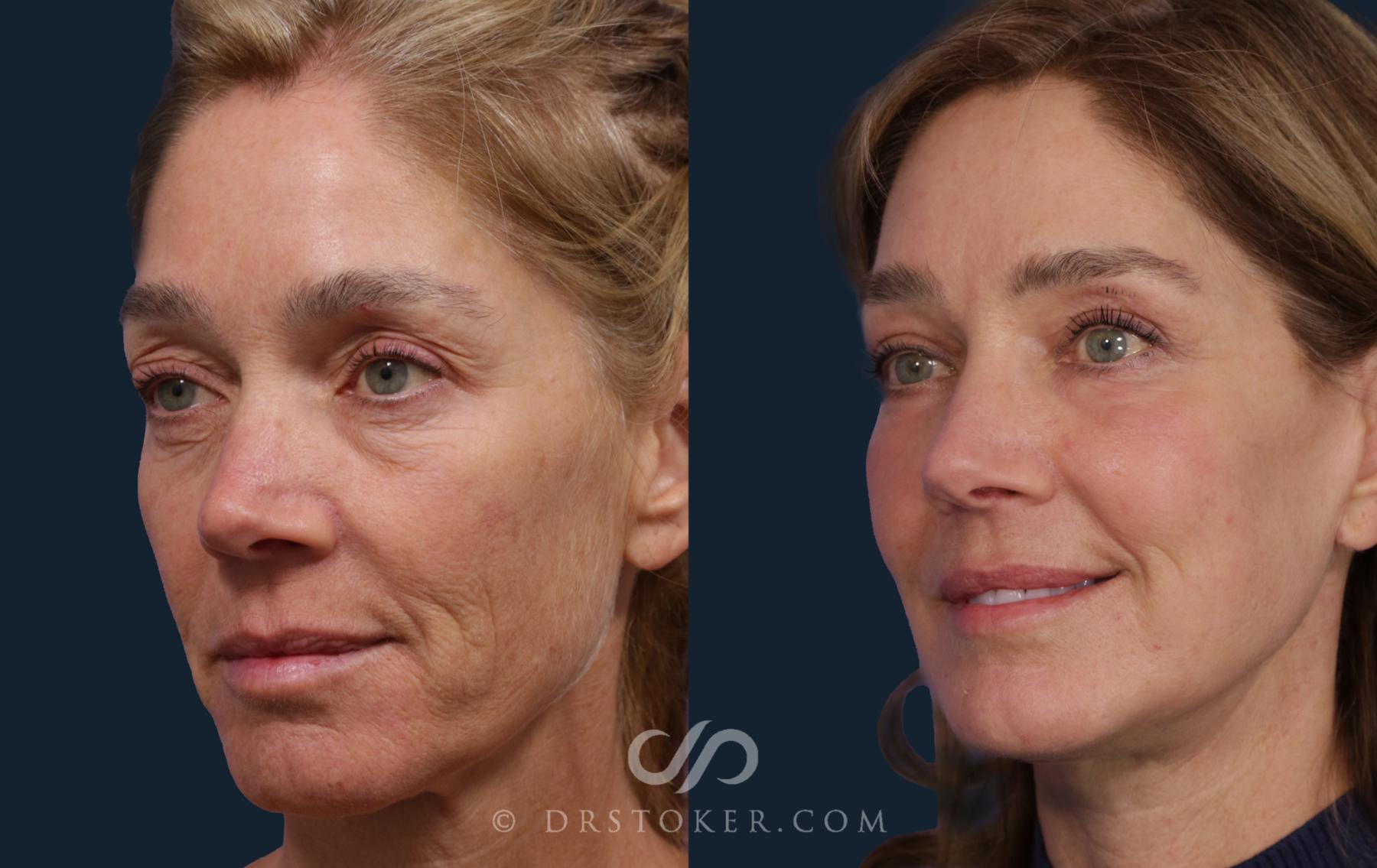 Before & After Facelift/Neck Lift (Deep Plane/Traceless) Case 2122 Left Oblique View in Los Angeles, CA