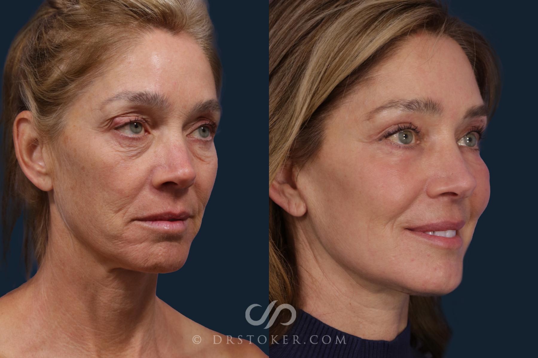 Before & After Facelift/Neck Lift (Deep Plane/Traceless) Case 2122 Right Oblique View in Los Angeles, CA