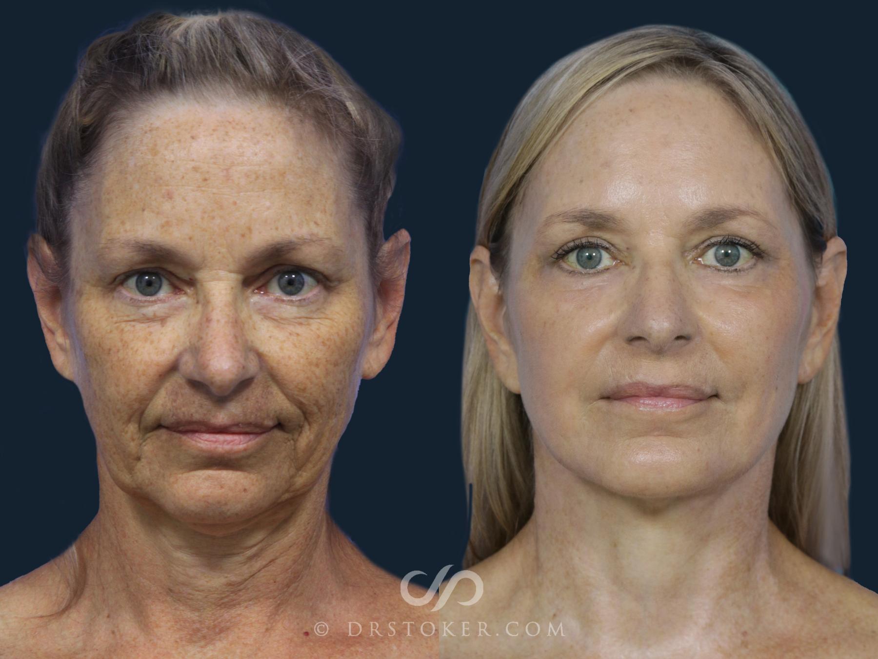 Before & After Facelift/Neck Lift (Deep Plane/Traceless) Case 2123 Front View in Los Angeles, CA