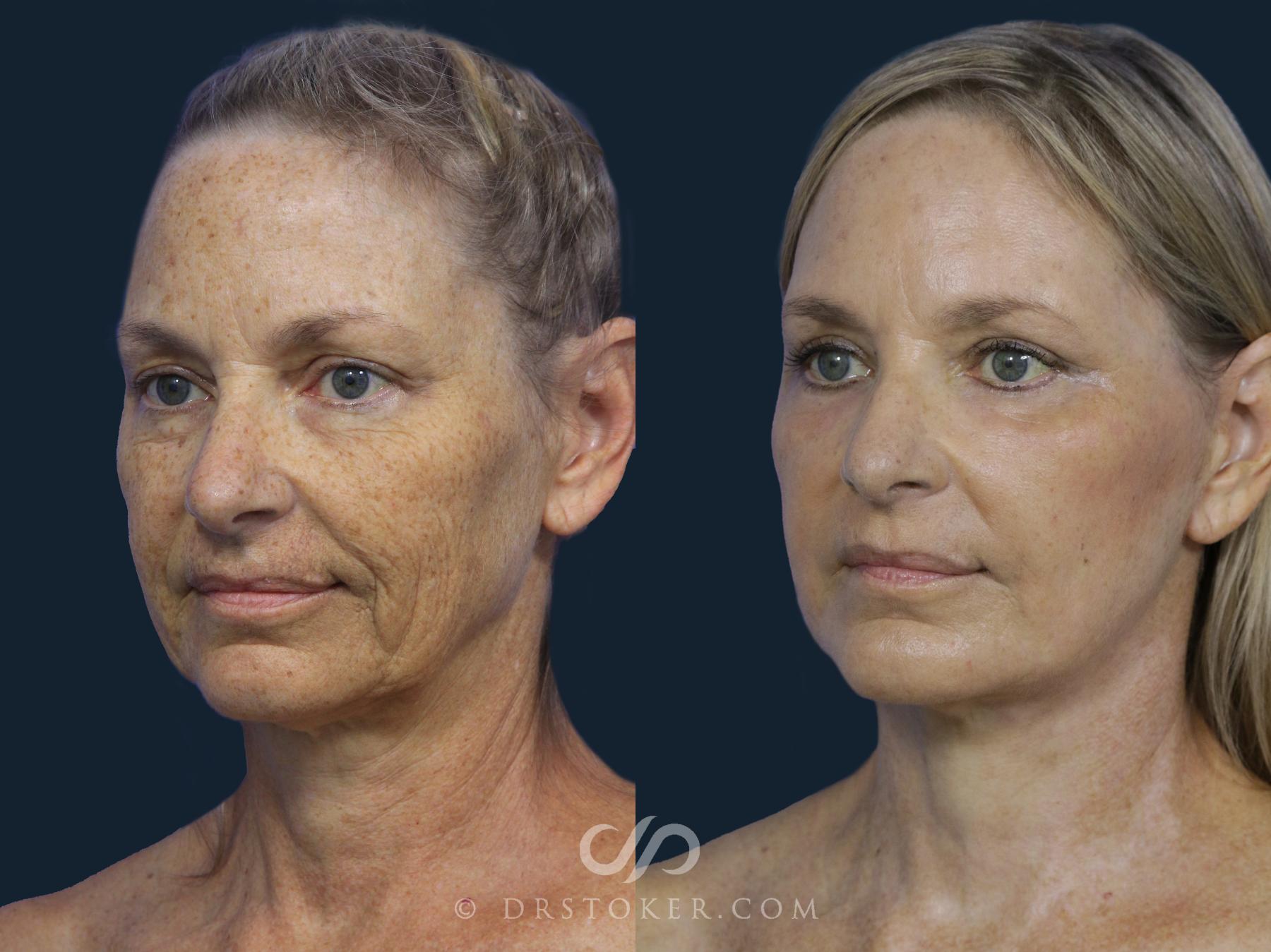 Before & After Facelift/Neck Lift (Deep Plane/Traceless) Case 2123 Left Oblique View in Los Angeles, CA