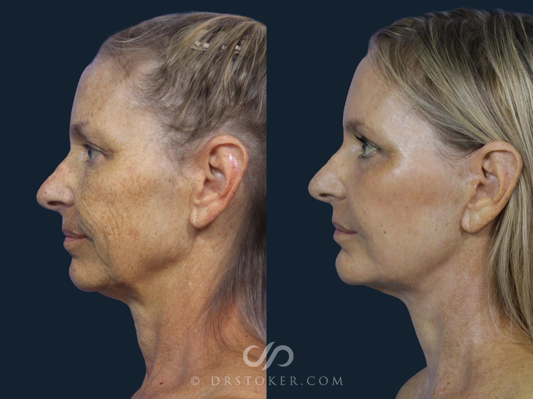 Before & After Facelift/Neck Lift (Deep Plane/Traceless) Case 2123 Left Side View in Los Angeles, CA