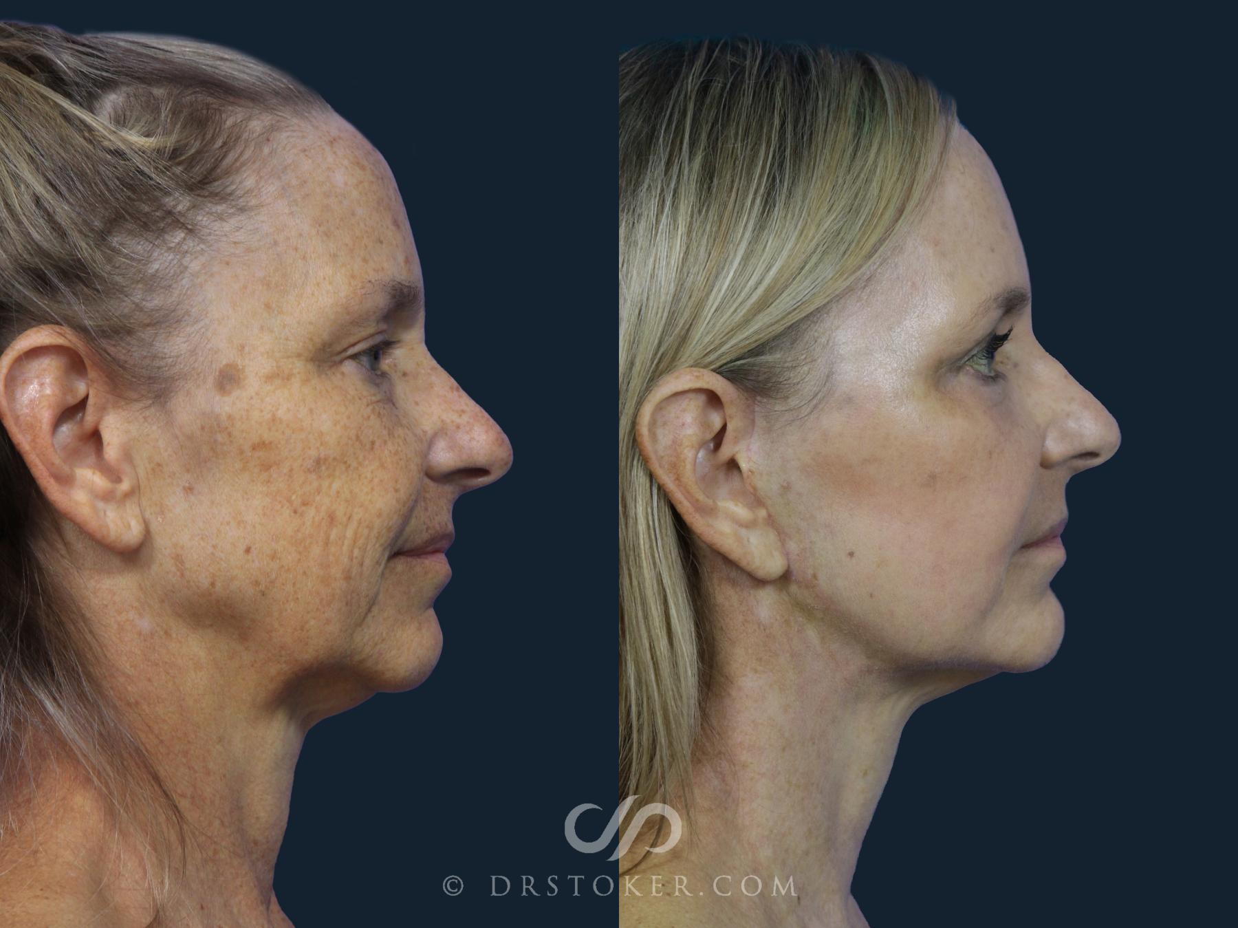 Before & After Facelift/Neck Lift (Deep Plane/Traceless) Case 2123 Right Side View in Los Angeles, CA