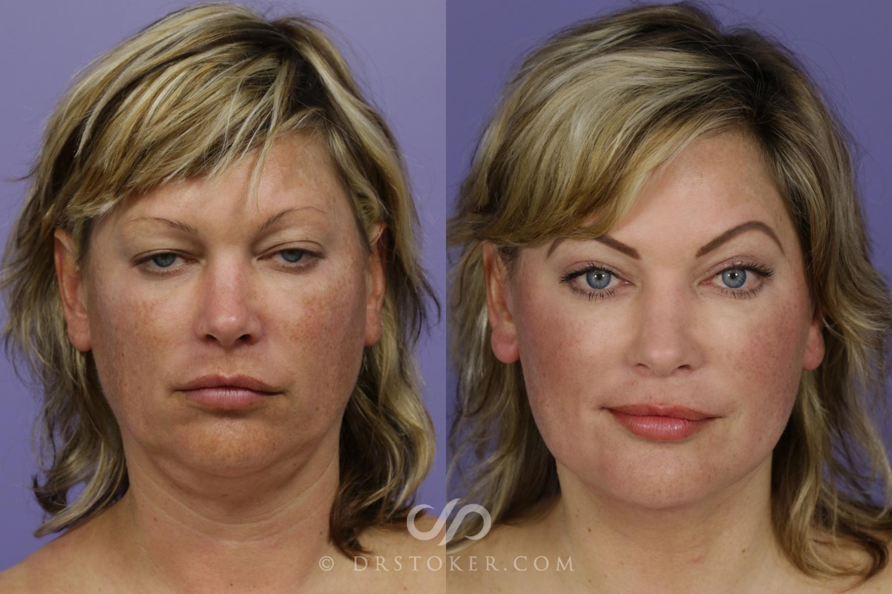 Before & After Facelift/Neck Lift (Deep Plane/Traceless) Case 2124 Front View in Los Angeles, CA