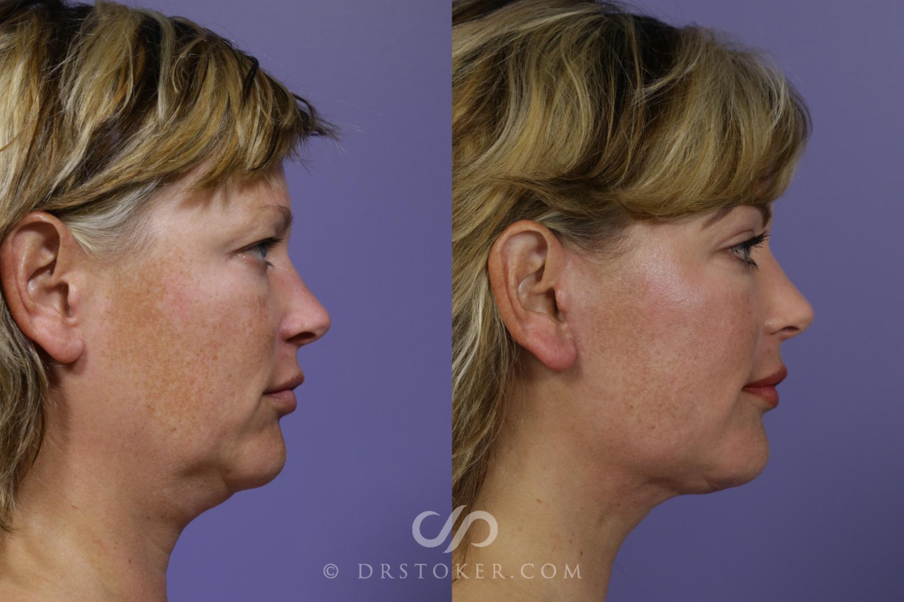 Before & After Facelift/Neck Lift (Deep Plane/Traceless) Case 2124 Right Side View in Los Angeles, CA