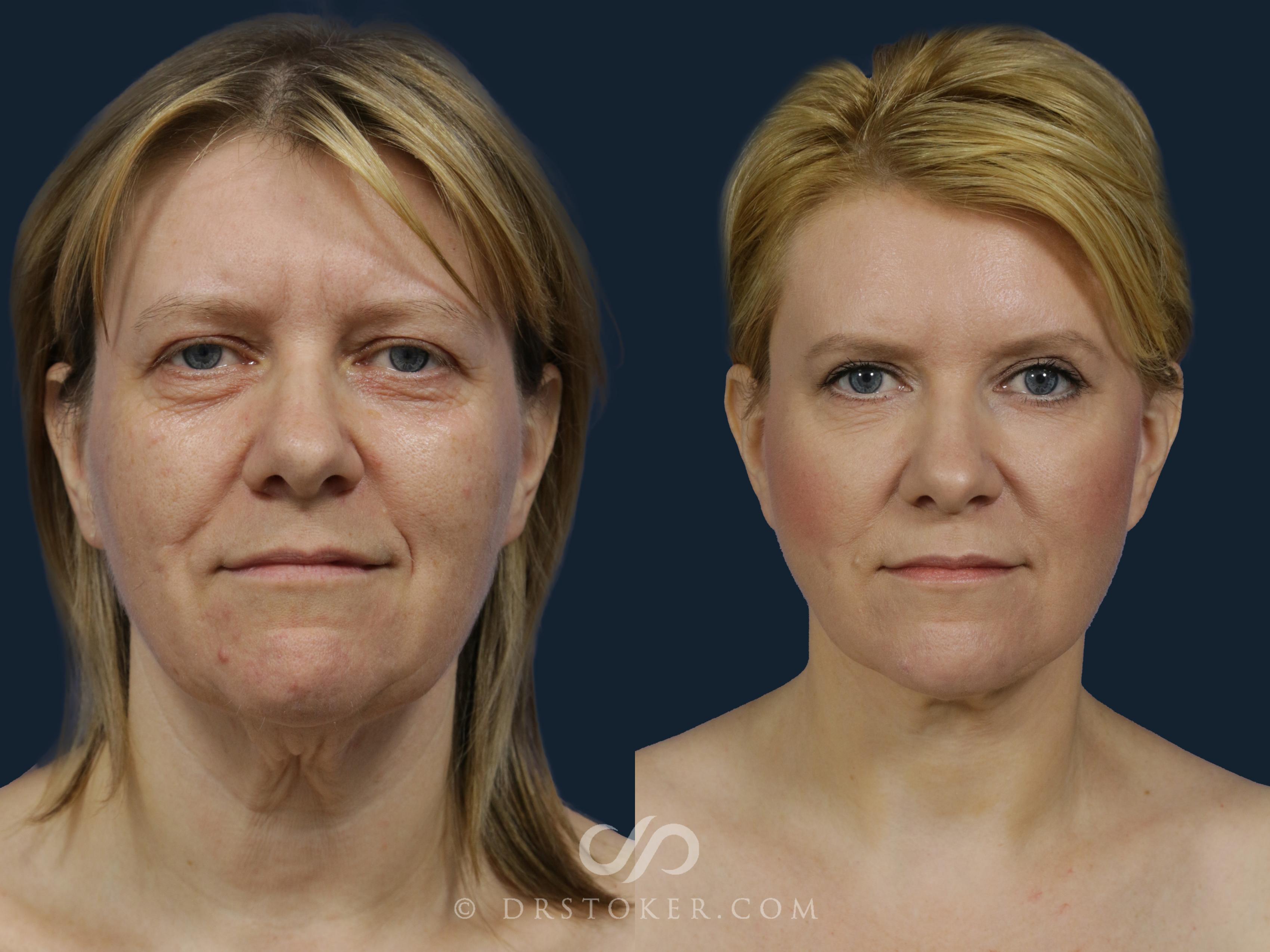 Before & After Facelift/Neck Lift (Deep Plane/Traceless) Case 2125 Front View in Los Angeles, CA