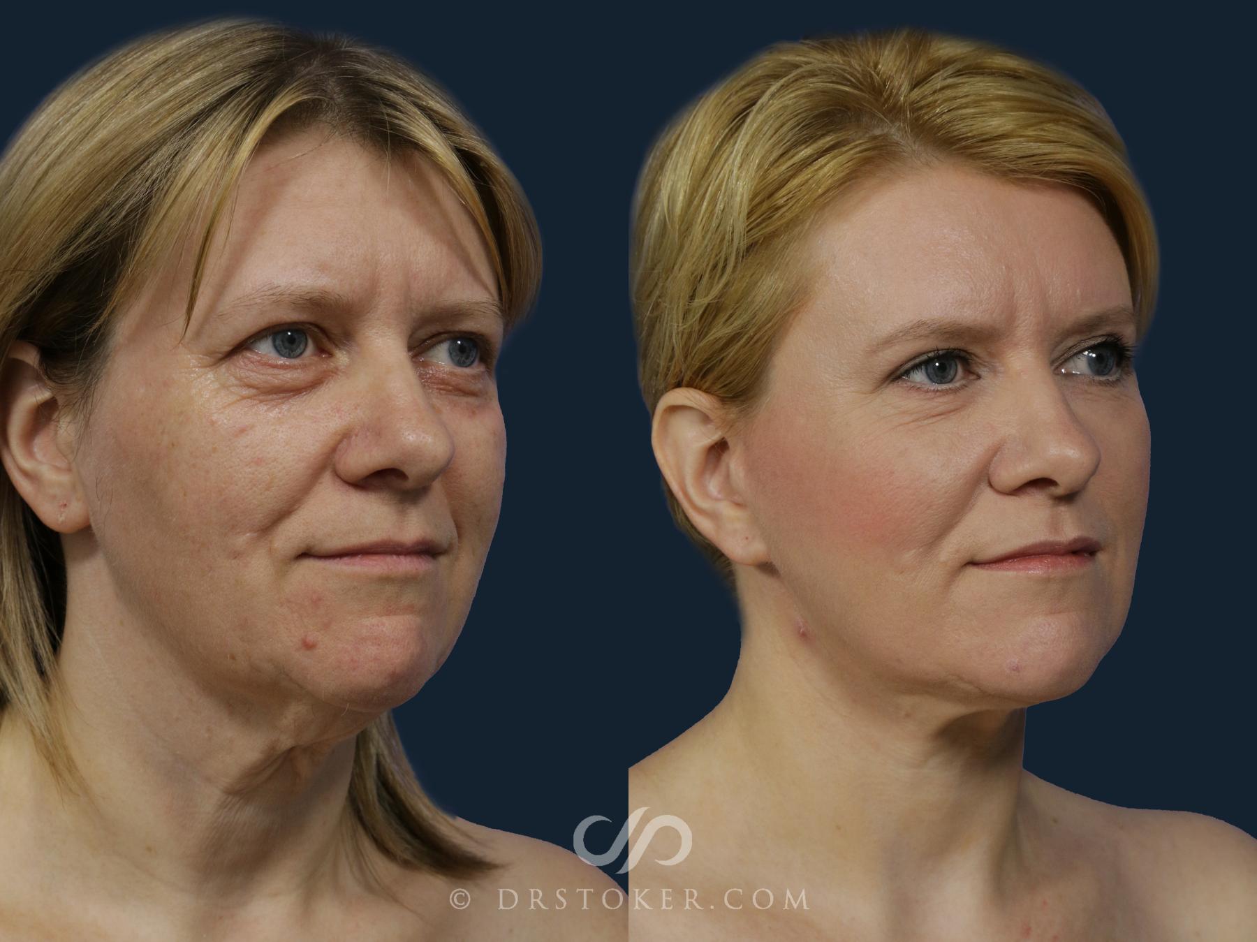 Before & After Facelift/Neck Lift (Deep Plane/Traceless) Case 2125 Left Oblique View in Los Angeles, CA