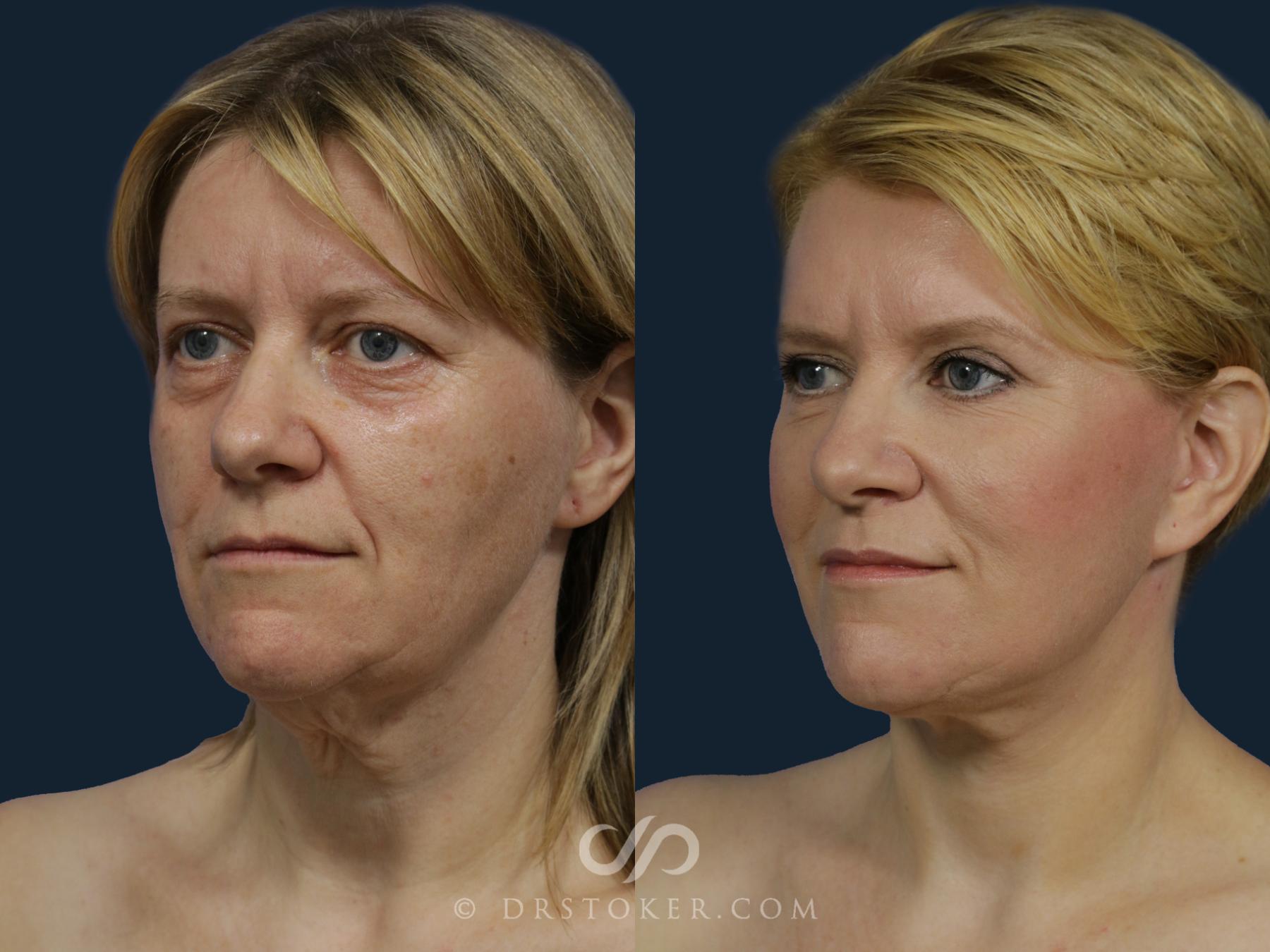 Before & After Facelift/Neck Lift (Deep Plane/Traceless) Case 2125 Right Oblique View in Los Angeles, CA