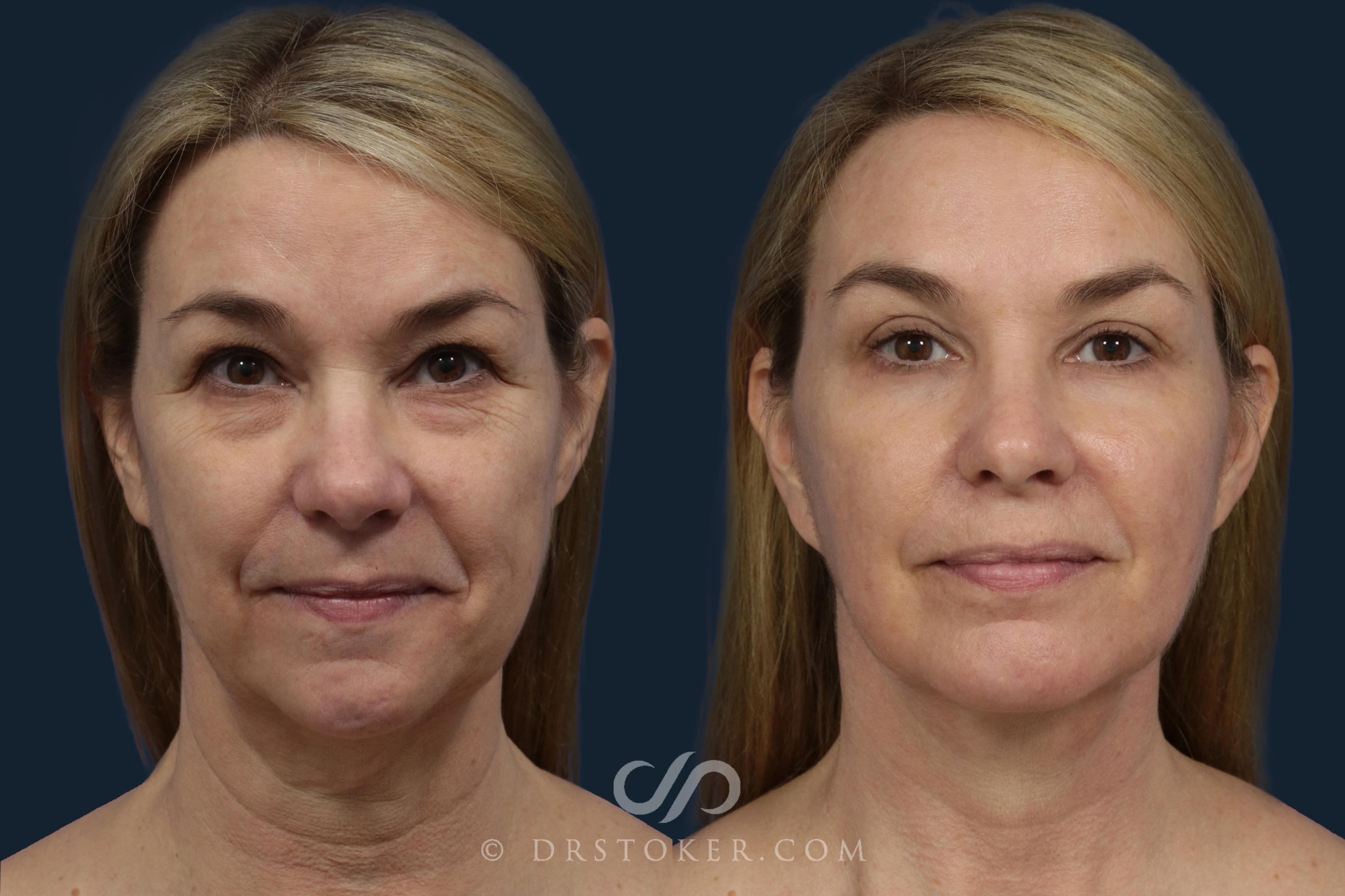 Before & After Facelift/Neck Lift (Deep Plane/Traceless) Case 2126 Front View in Los Angeles, CA