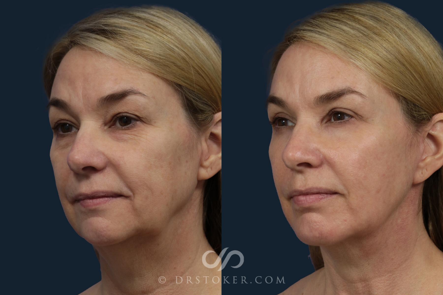 Before & After Facelift/Neck Lift (Deep Plane/Traceless) Case 2126 Left Oblique View in Los Angeles, CA