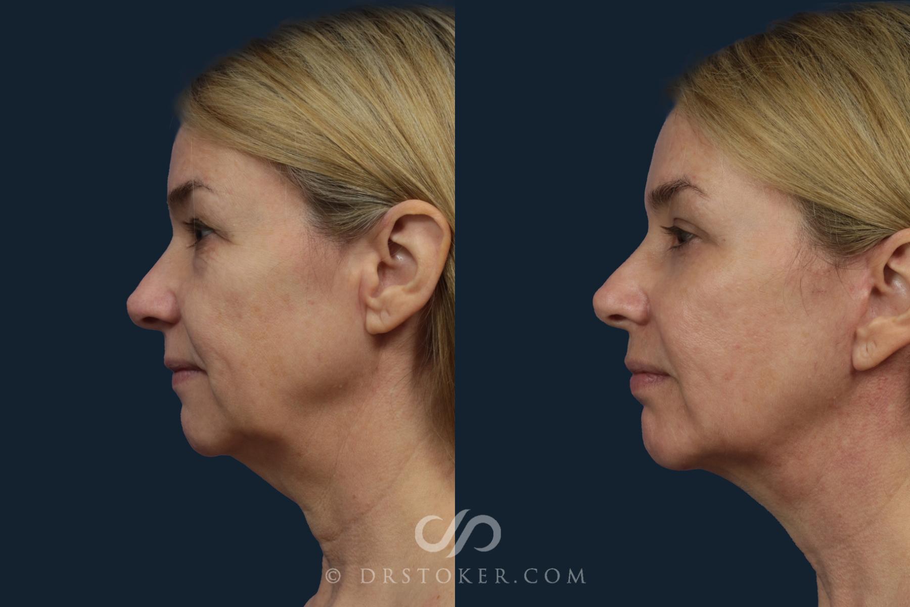 Before & After Facelift/Neck Lift (Deep Plane/Traceless) Case 2126 Left Side View in Los Angeles, CA
