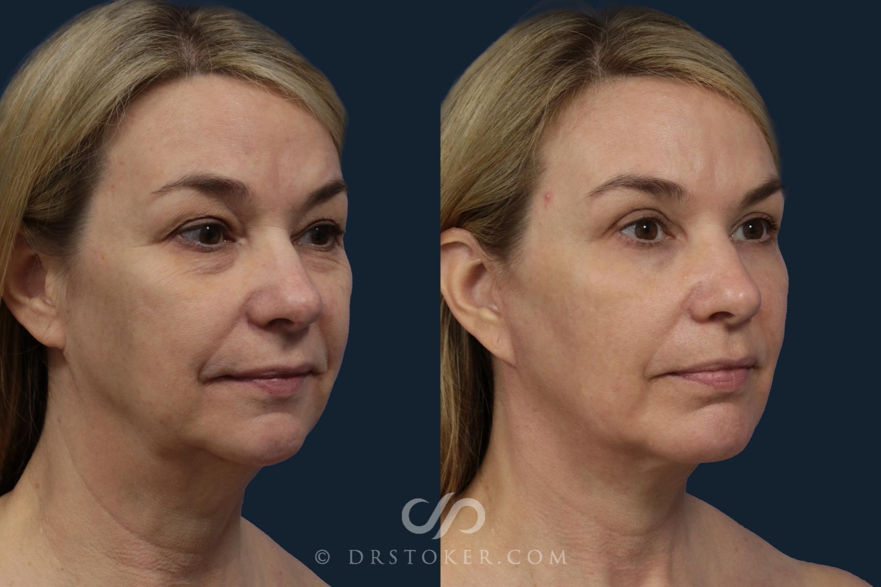 Before & After Facelift/Neck Lift (Deep Plane/Traceless) Case 2126 Right Oblique View in Los Angeles, CA